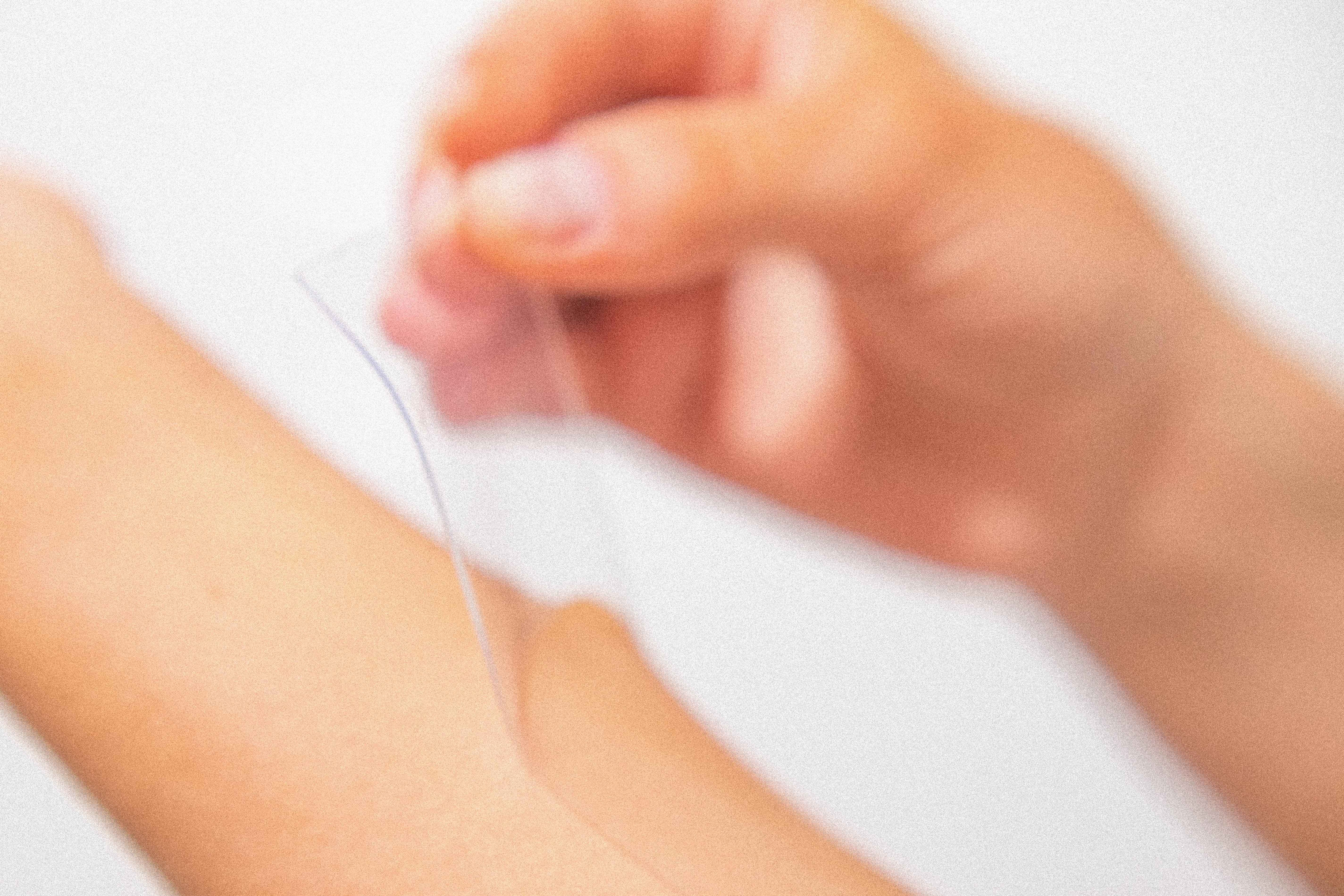 Scar cream for burn contracture release surgery scars