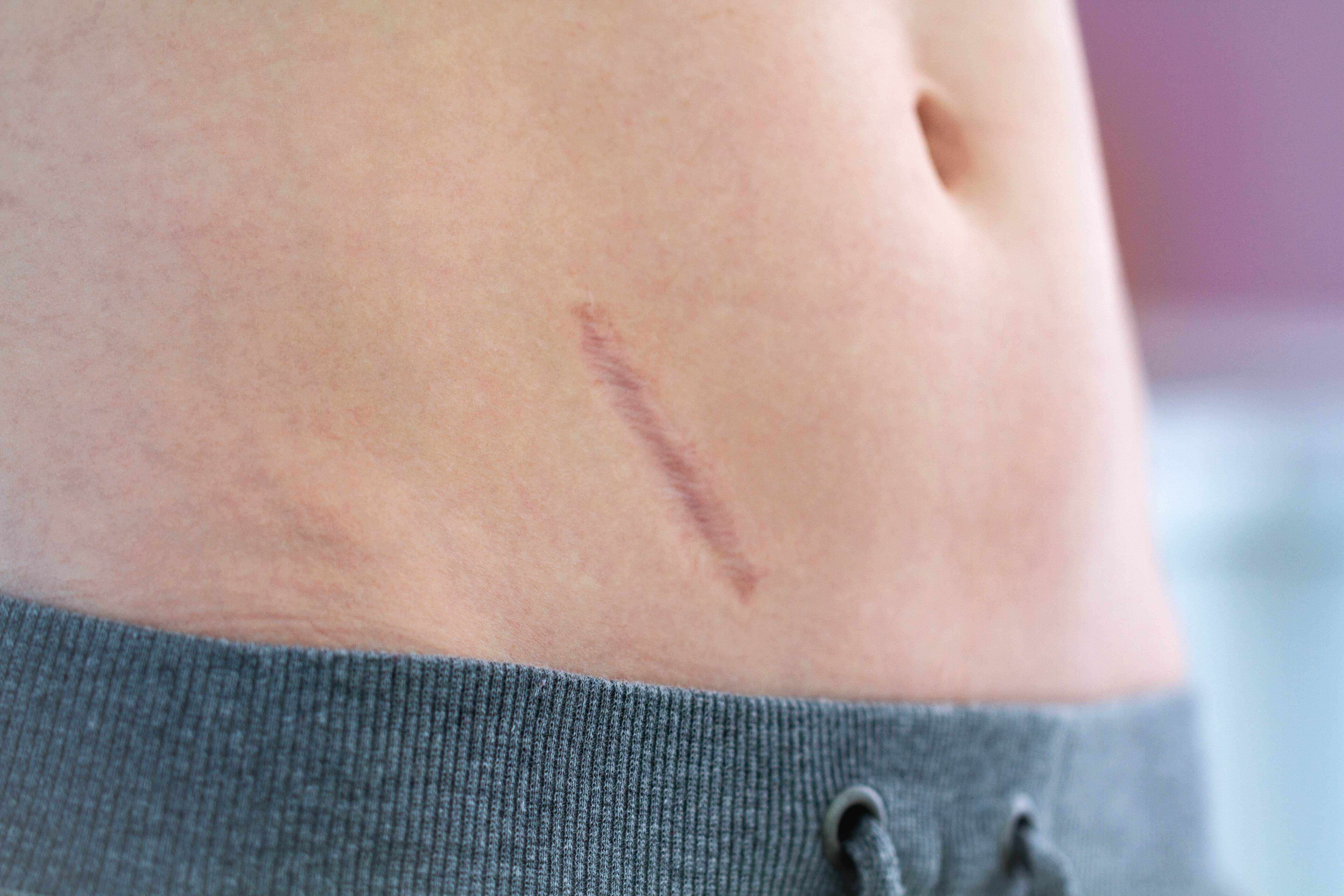 What Your Patients Need to Minimize a Scar in 2022