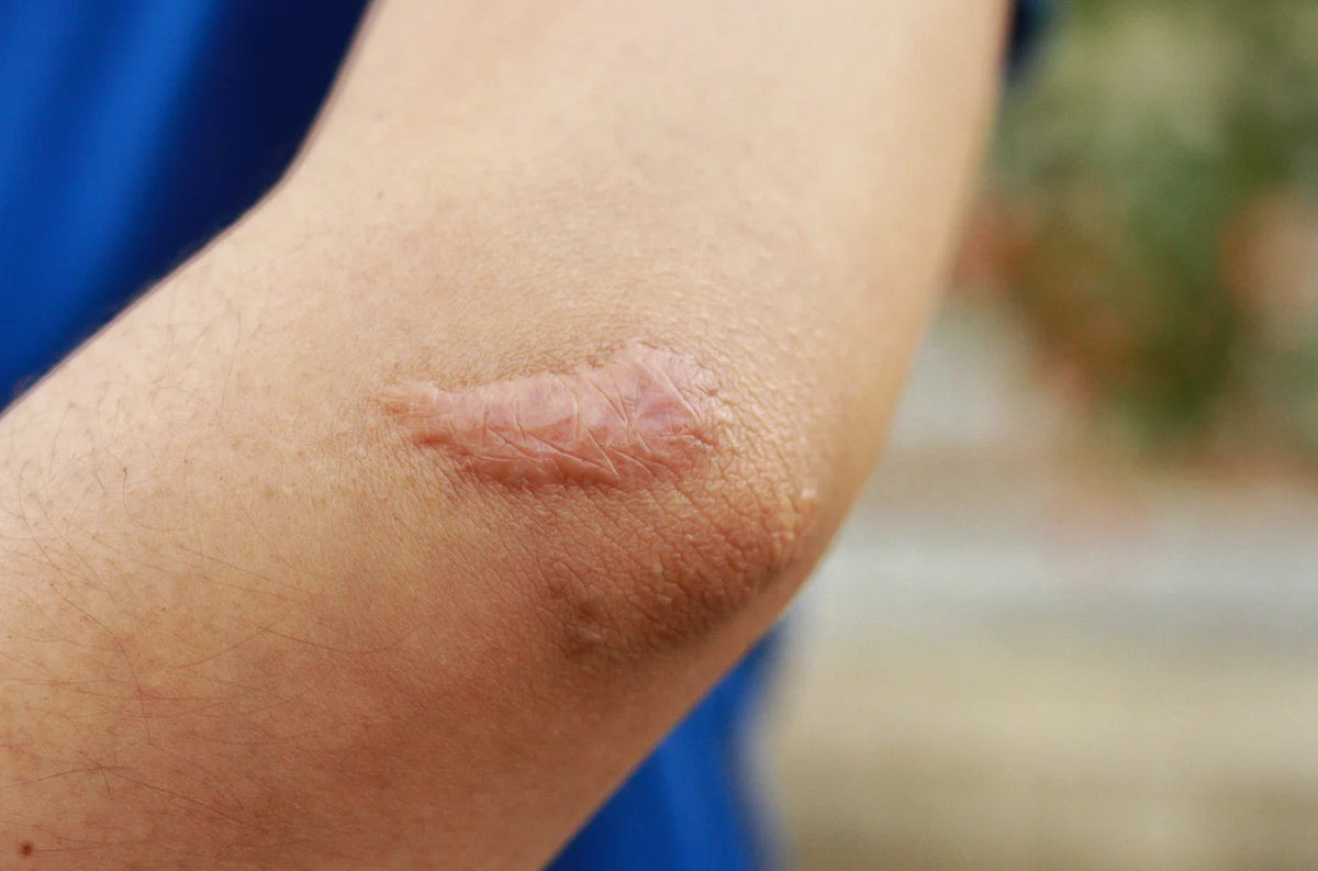Why Do Some People Scar More Than Others? Risk Factors and Prevention Tips