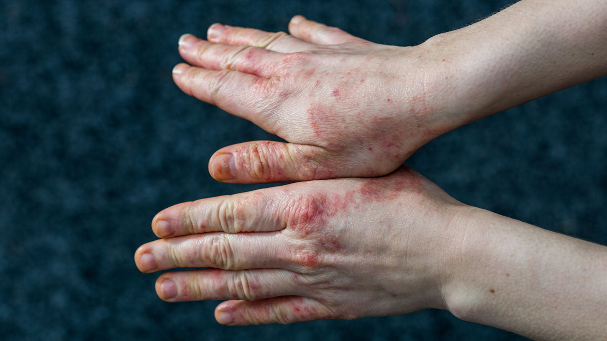 Exploring Eczema Varieties