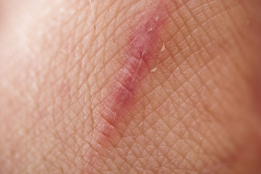 Article image: Facts about scarring