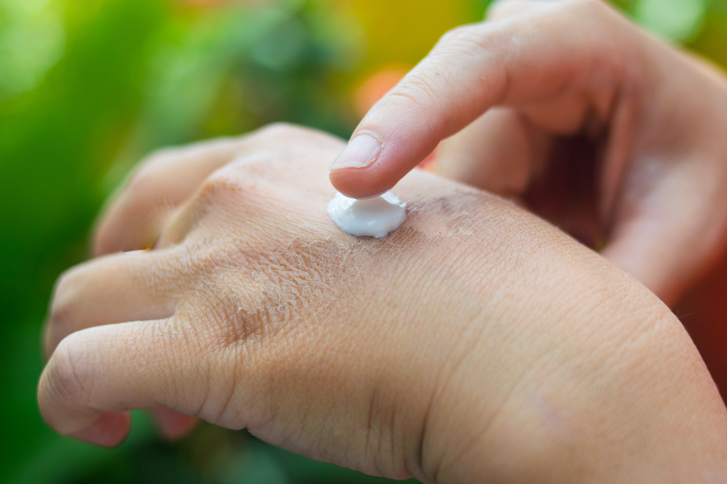 How to Treat Scars Caused by Burns