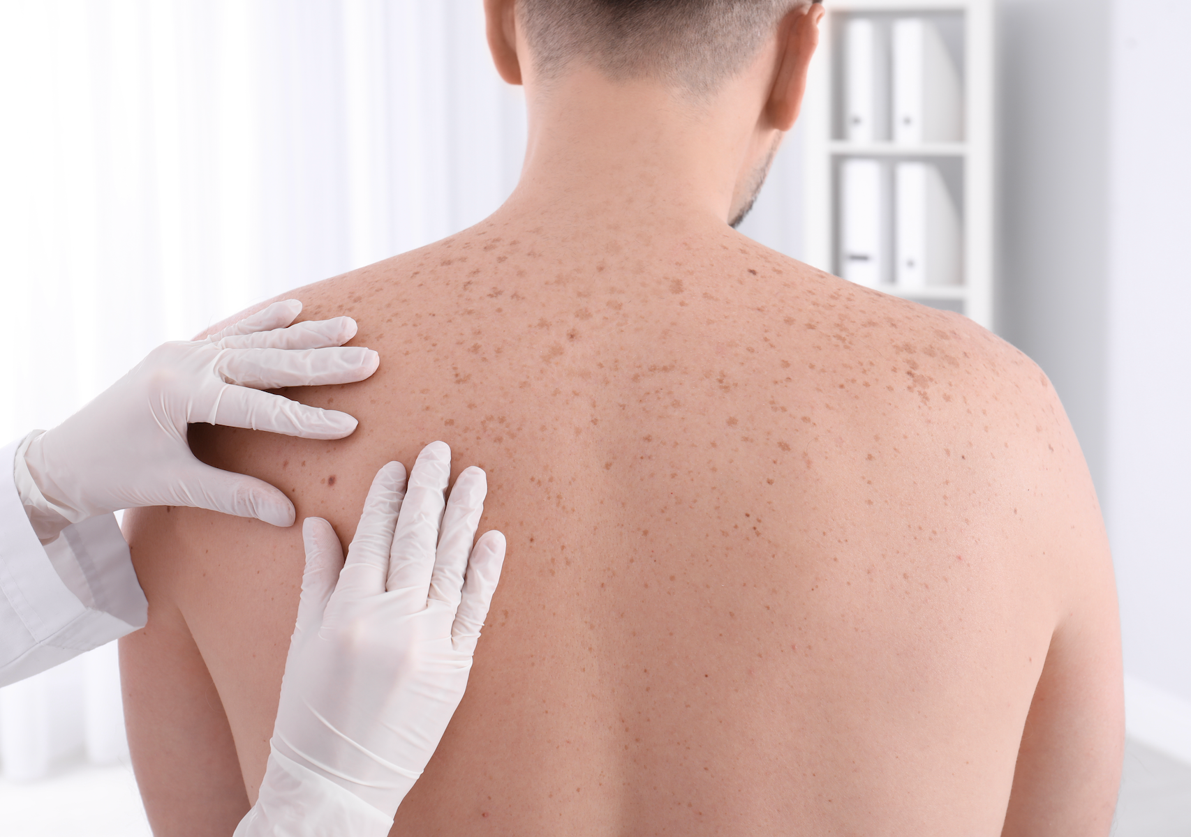 What Are The 4 Types of Skin Cancer?