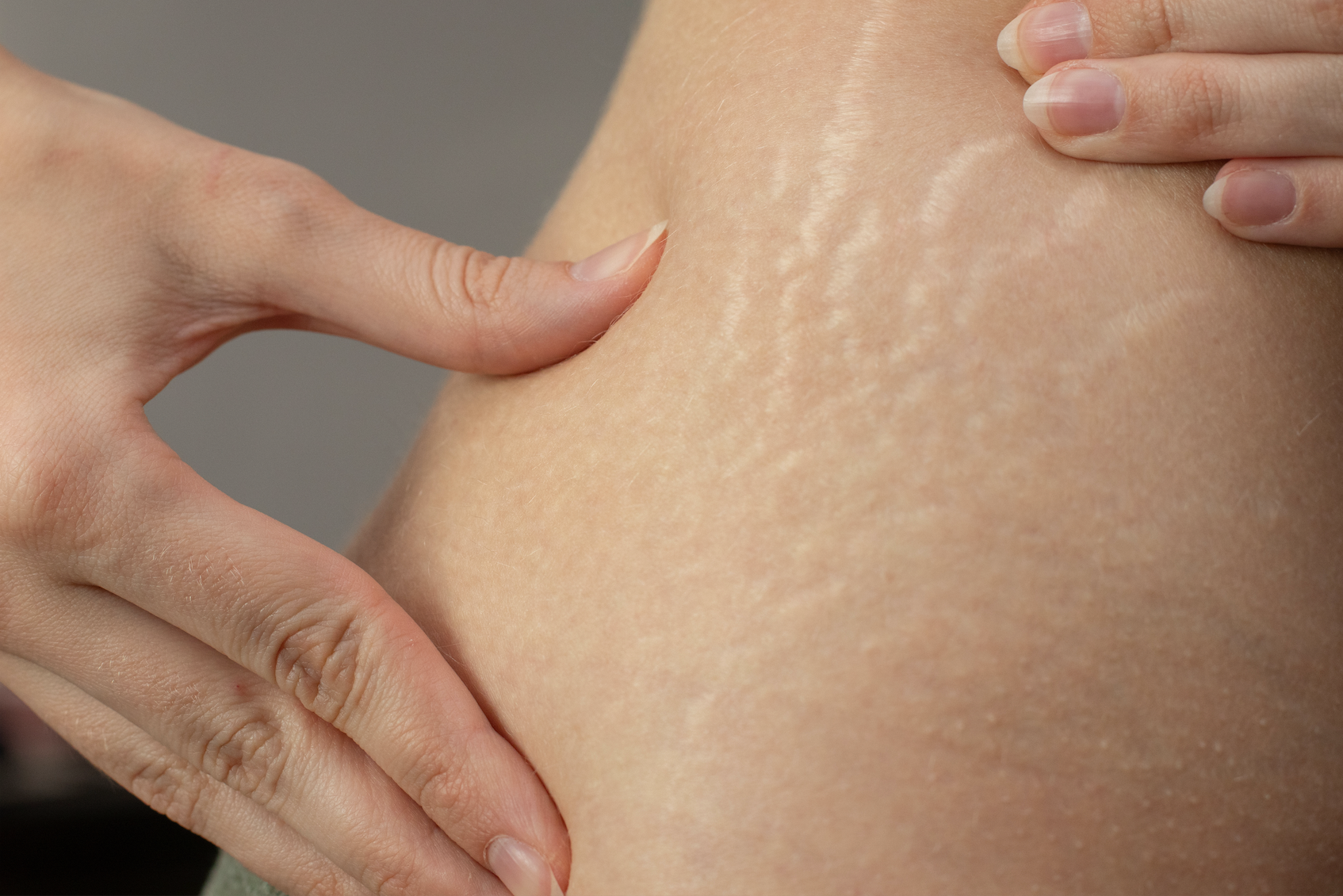 Reducing The Appearance Of Your Stretch Marks