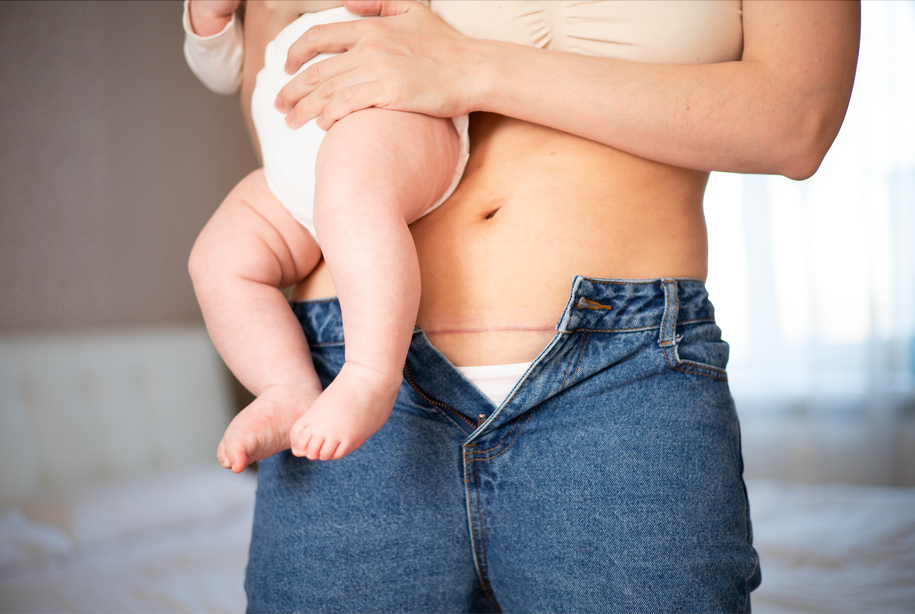 How To Heal Your C-Section Scar