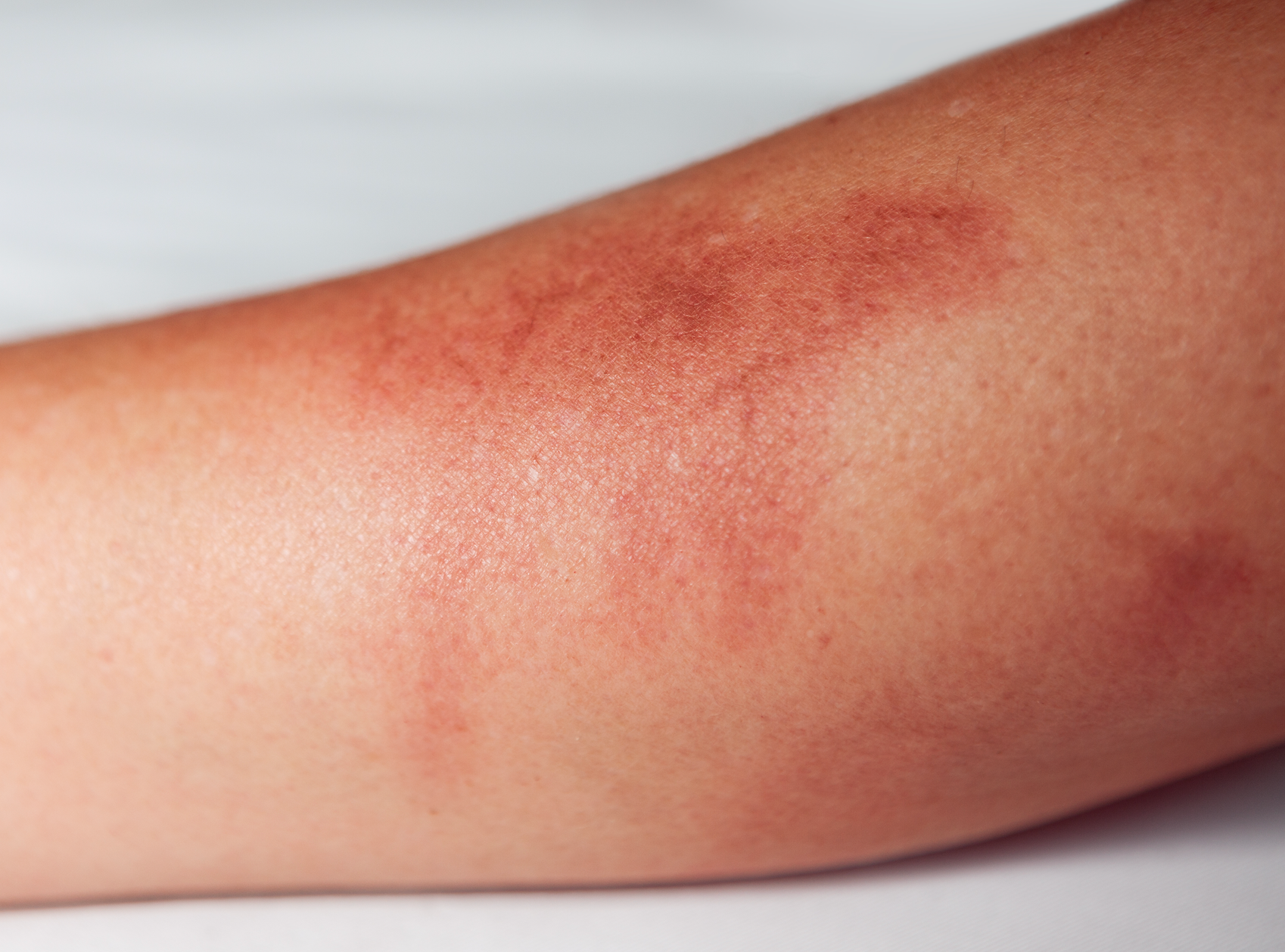 How Long Does It Take Radiation Burns to Heal? – Your Complete Guide to Skin Recovery