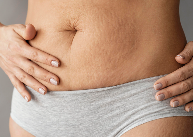 5 Stretch Marks Myths Debunked