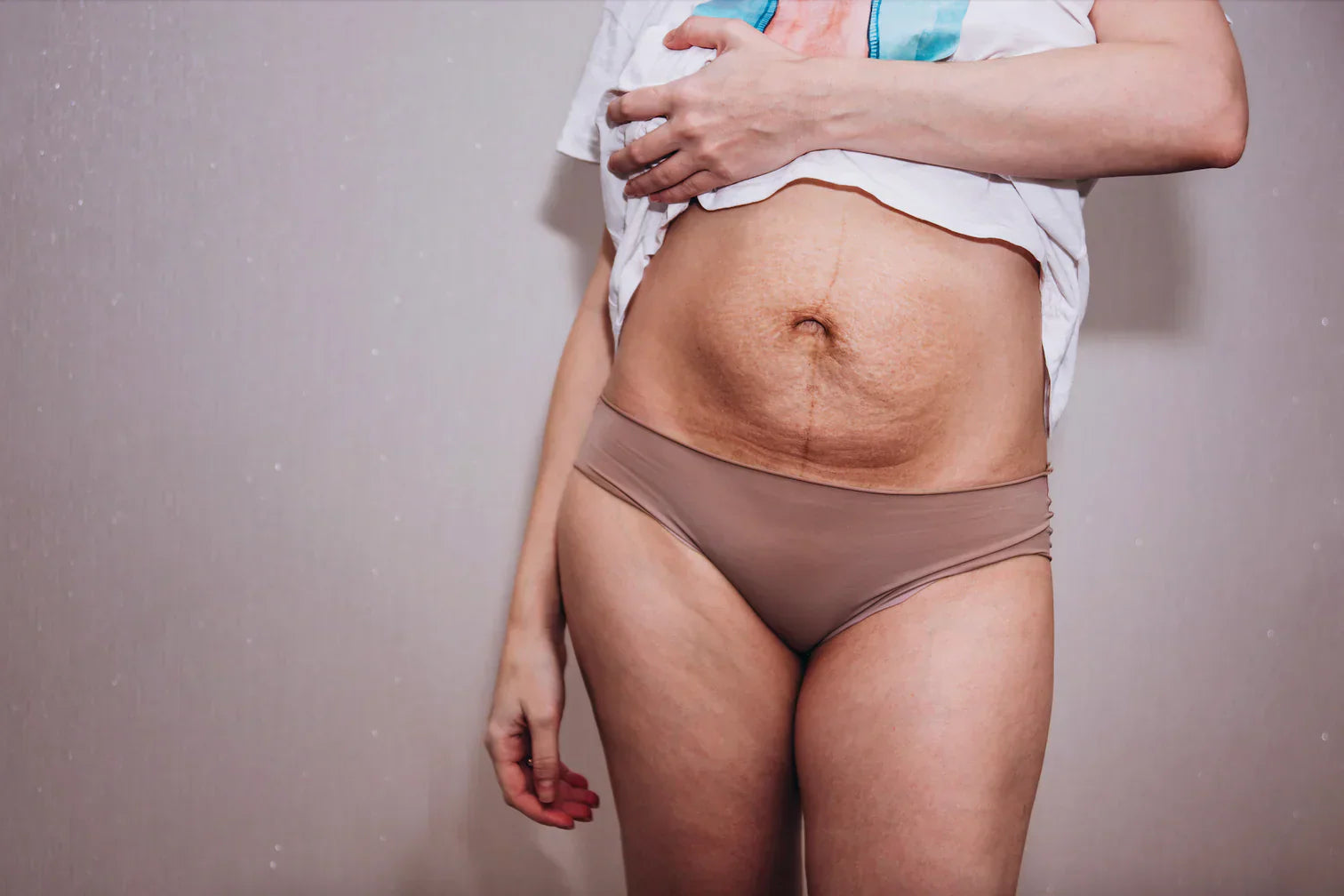 Can You Get Stretch Marks from Losing Weight?