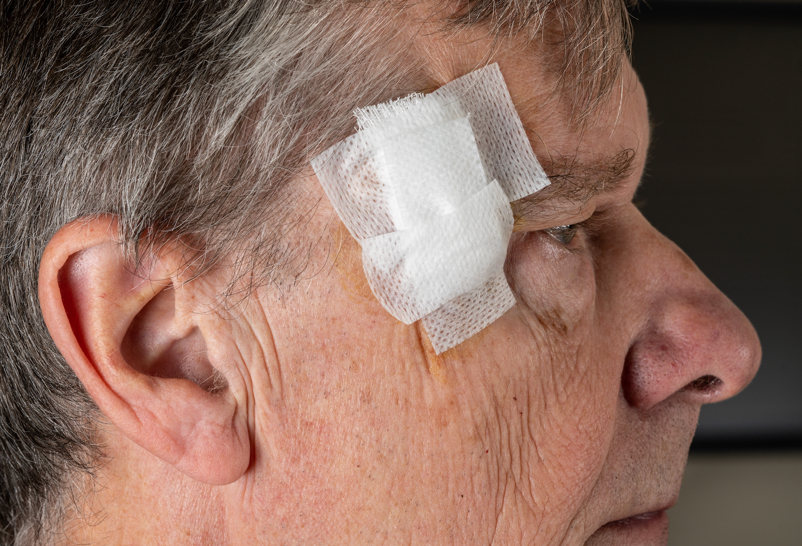 How To Treat Your Scar After Mohs Surgery