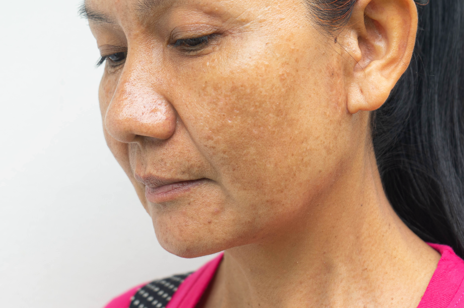 What Are The Different Types of Hyperpigmentation? || what causes hyperpigmentation, how to treat hyperpigmentation, most common type of hyperpigmentation
