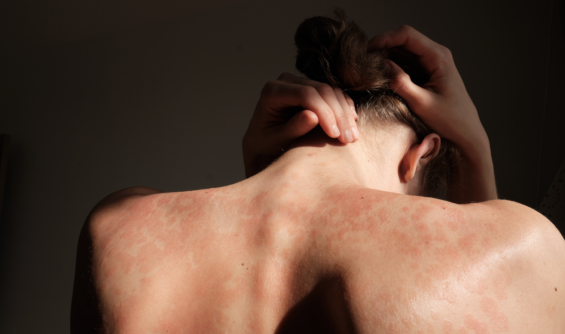 5 Signs You May Have Psoriasis || psoriasis symptoms, what causes psoriasis, what does psoriasis look like
