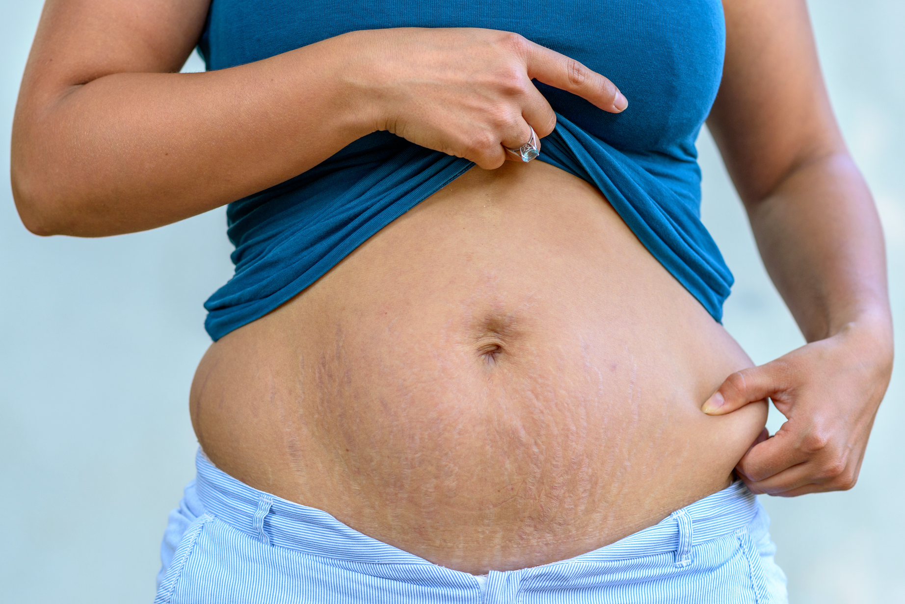 What Are The Types of Stretch Marks || what type of stretch marks do I have, what do different color stretch marks mean, how to treat stretch marks