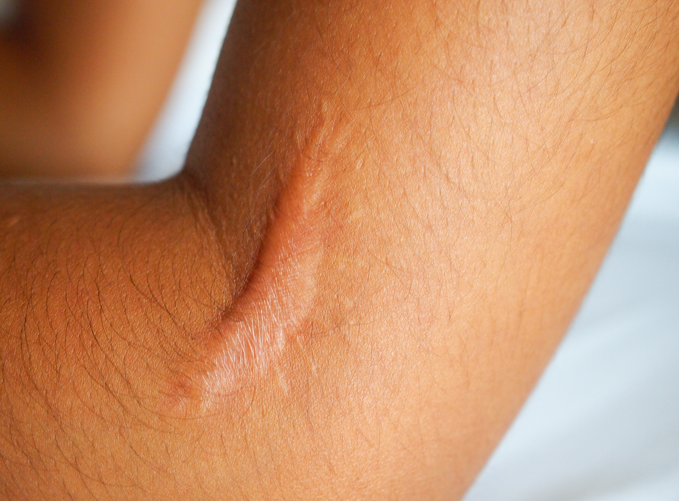 Understanding Keloids: How They Form and Effective Prevention Methods | what causes keloids, how to stop a keloid from forming, signs a keloid is forming