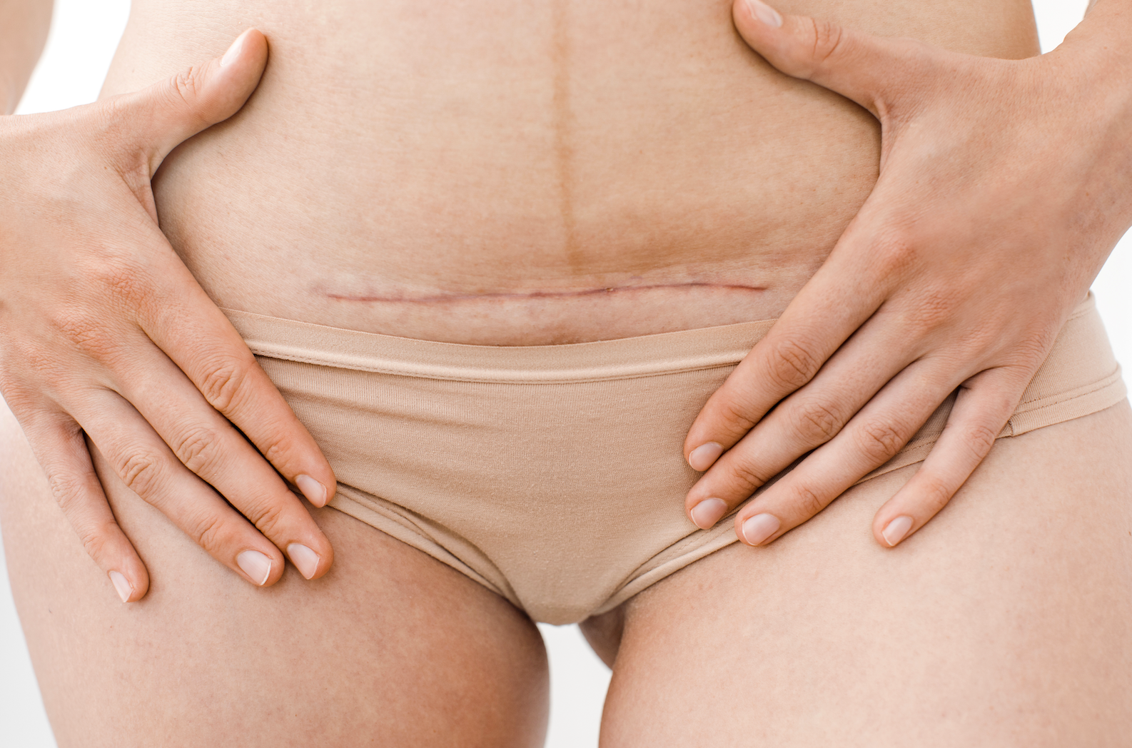 A Closer Look: C-Section Incision Types || what do c-section scars look like, how to heal c-section scar, c-section recovery time