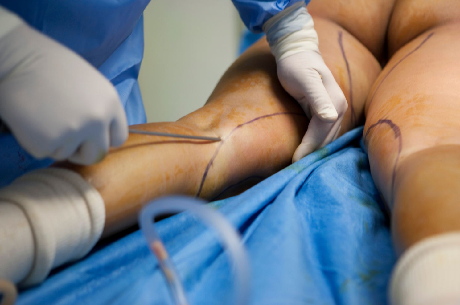 Does Liposuction Leave Scars? || what happens during liposuction, what do liposuction scars look like, how to get rid of liposuction scars