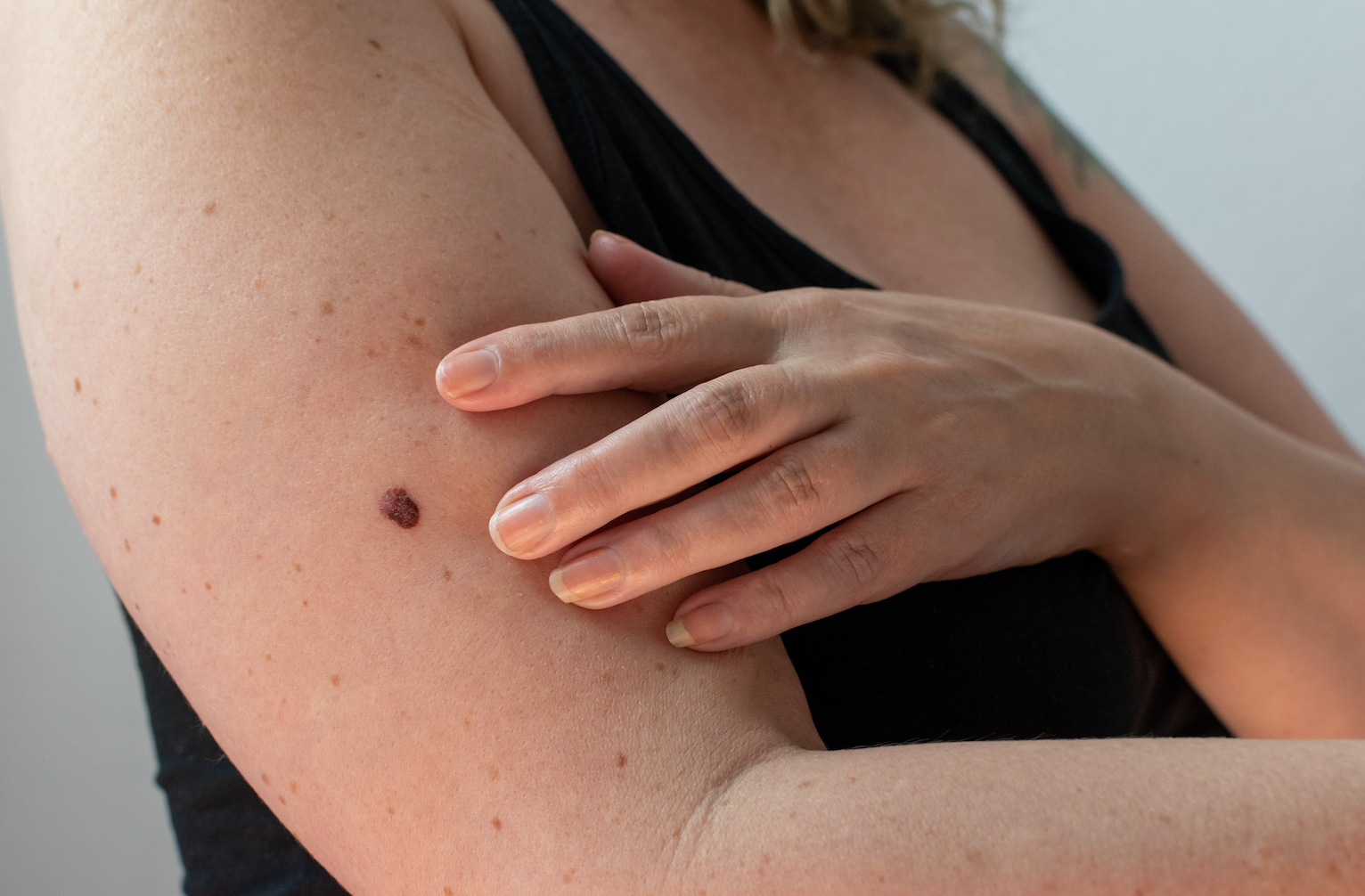 What Is Melanoma: The Most Dangerous Form of Skin Cancer || what does melanoma look like, melanoma treatment, stages of melanoma