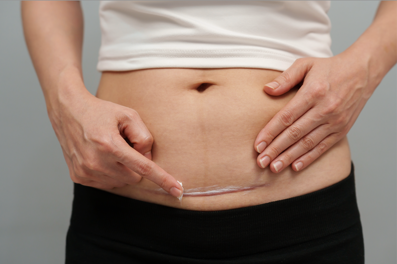 How To Get Rid Of My C-Section Scar || does a c-section scar go away, how long does it take a c-section wound to heal, c-section scar treatment
