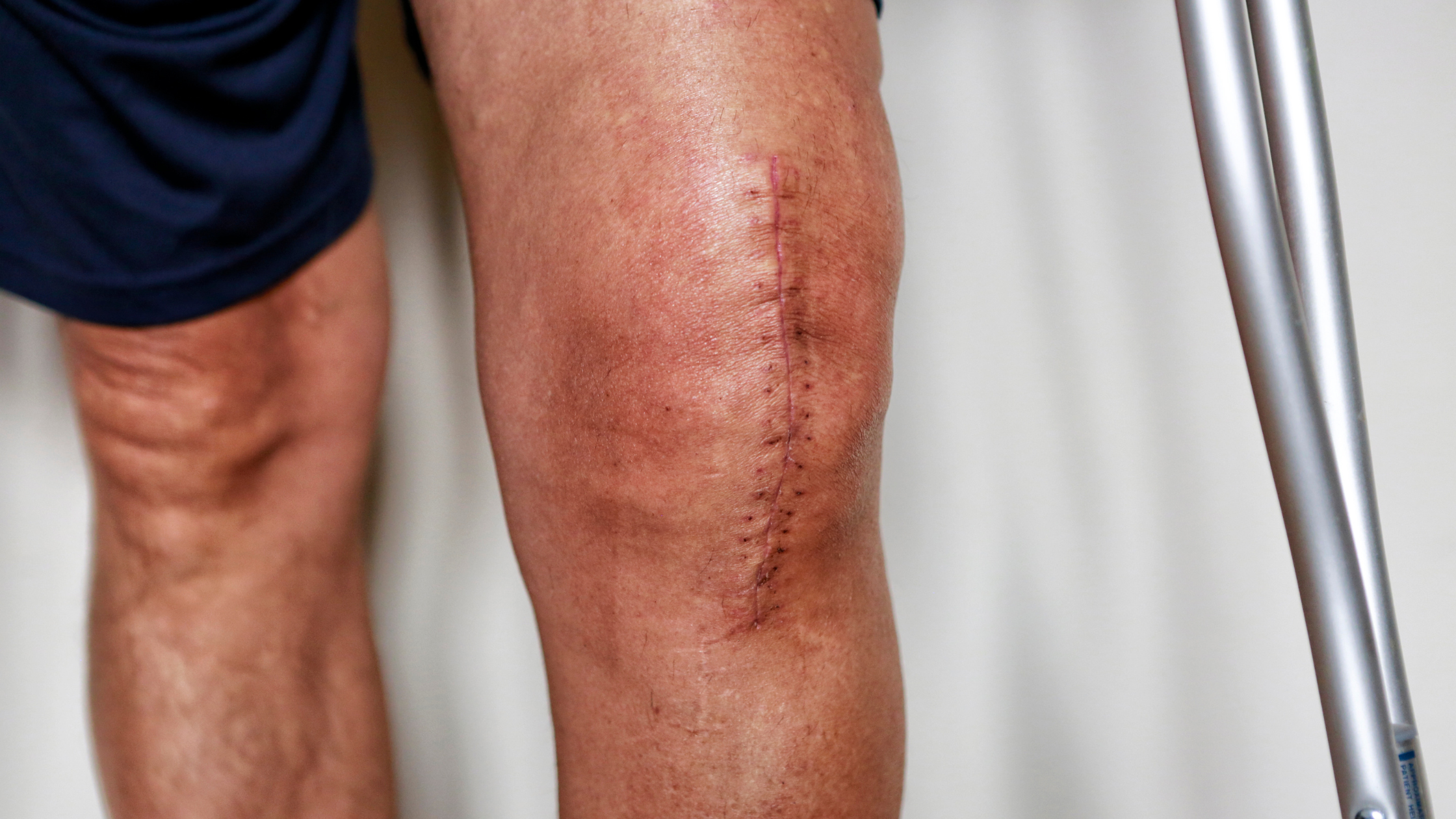 Scar Cream for Knee Replacement Scars: 2026 Verdicts