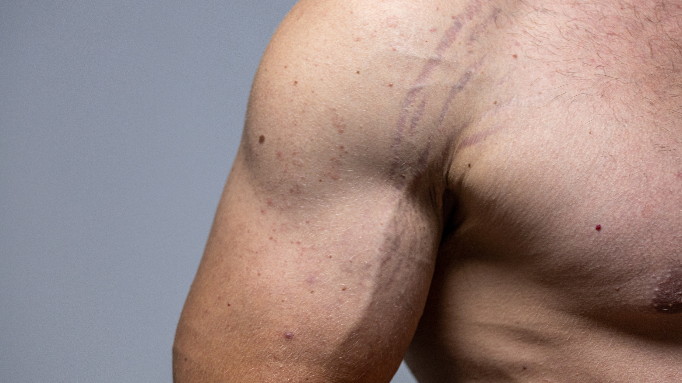 Men and Stretch Marks: Breaking the Stigma and Finding Real Solutions