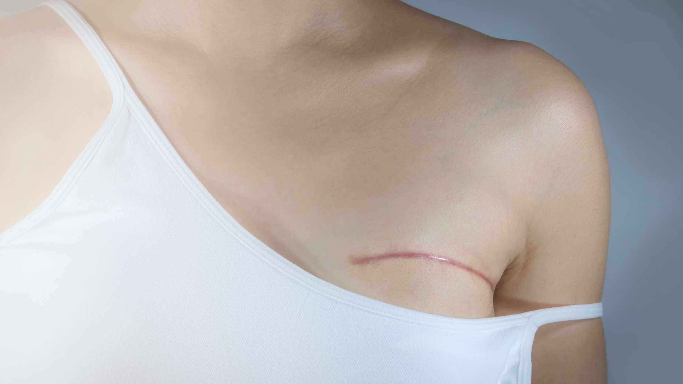 Best Scar Gel for Mastectomy Scars in 2026: Buy or Skip