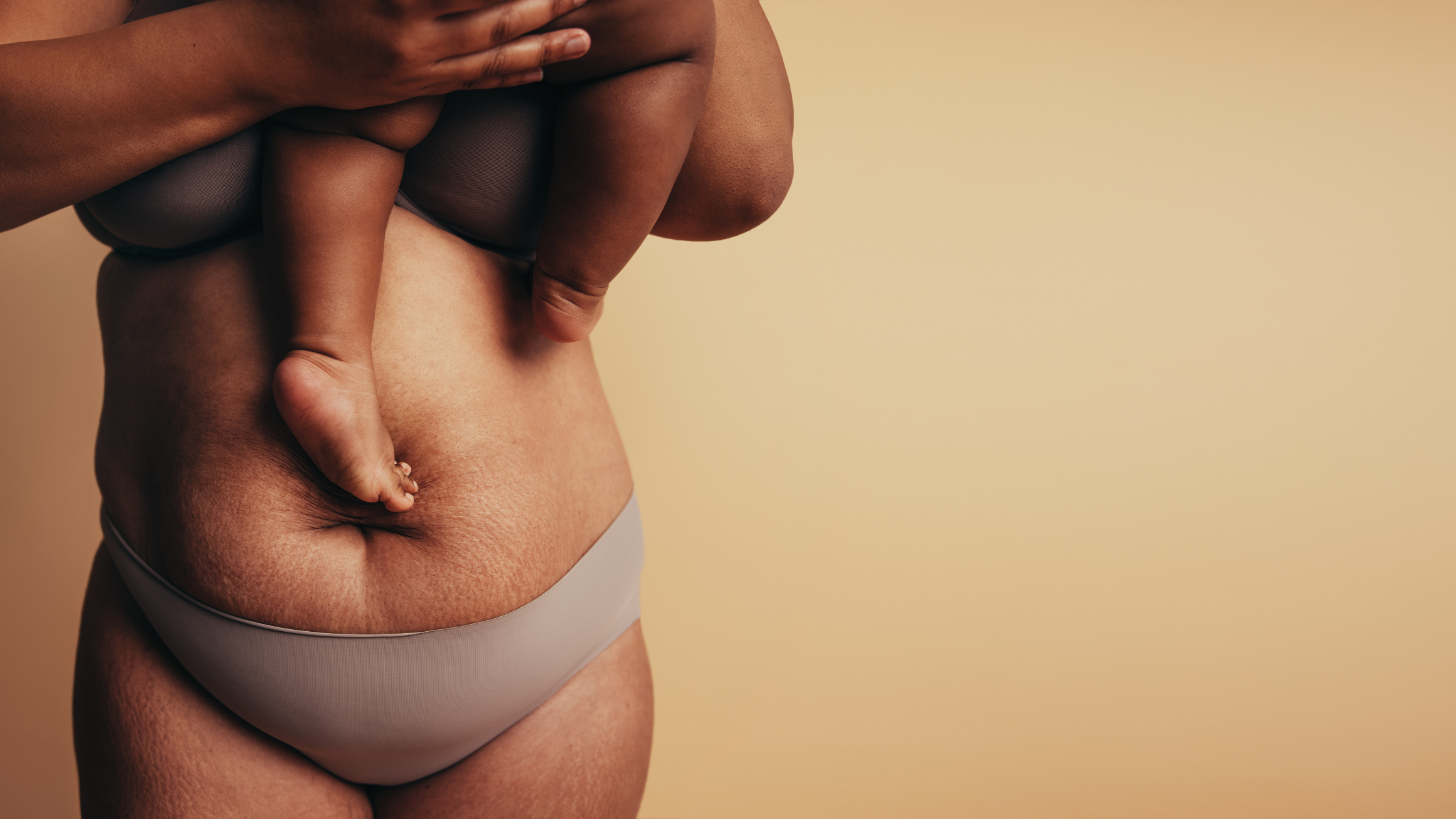 Postpartum Stretch Mark Recovery Timeline & Milestones