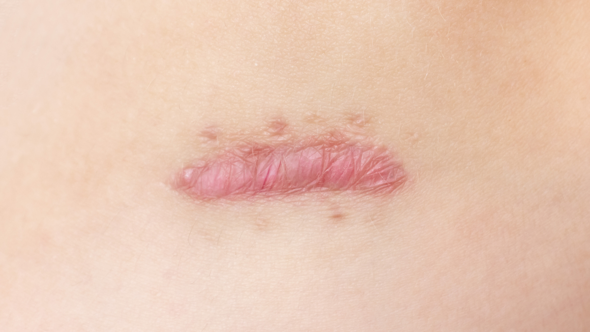 Best Silicone Gel for Hypertrophic Scars in 2026: Ranked