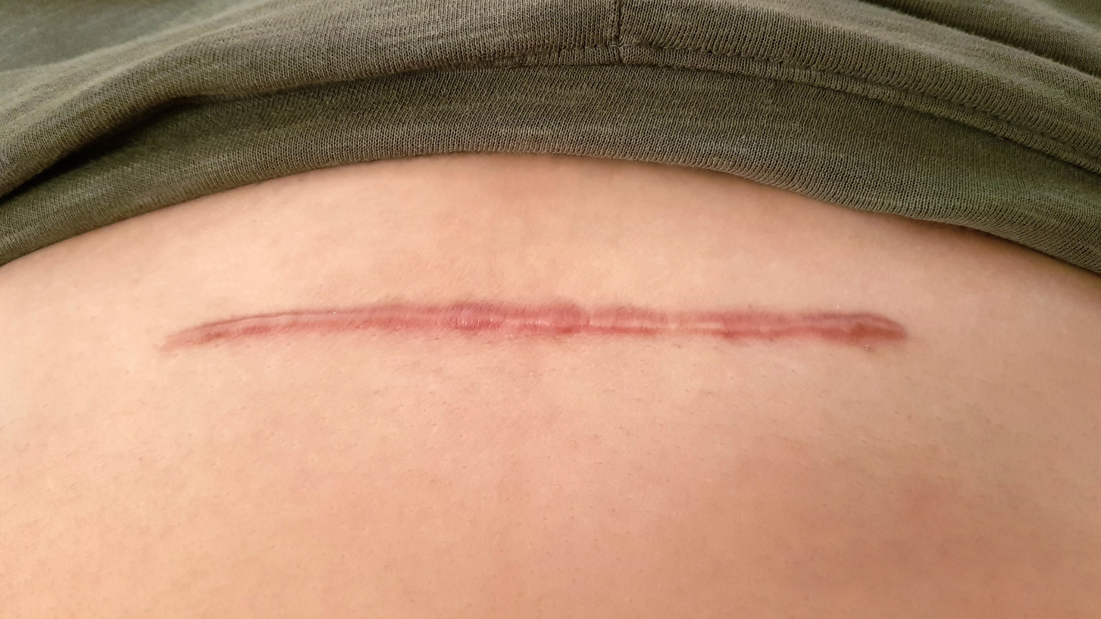 How to Use Silicone Scar Sheets for Best Results (2026)