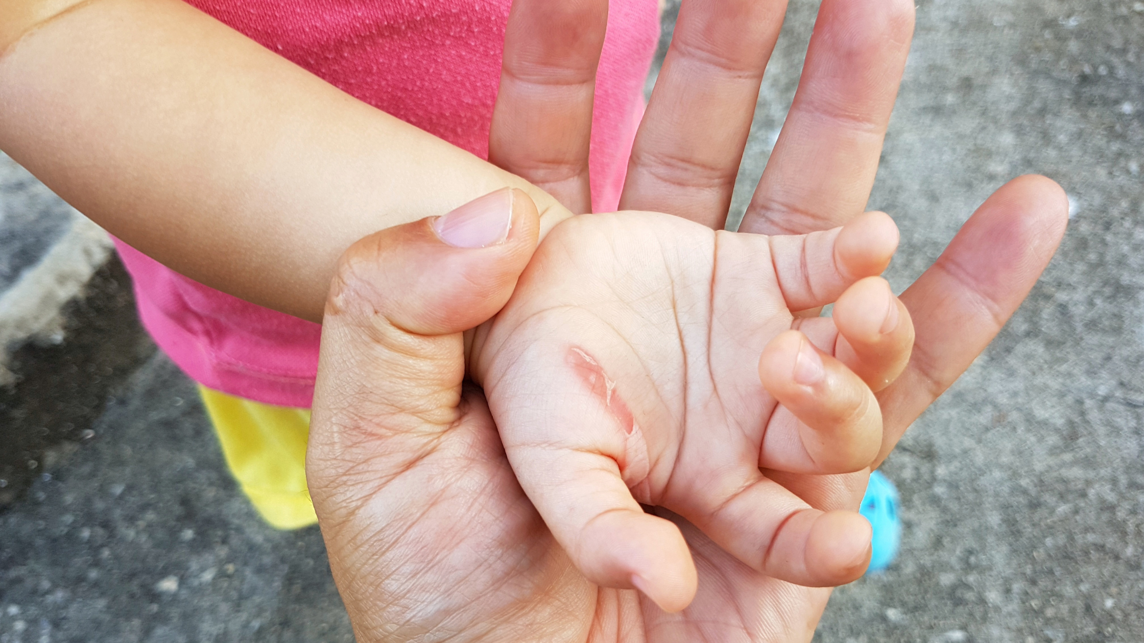 Best Scar Cream for Burn Scars in Children (2026)
