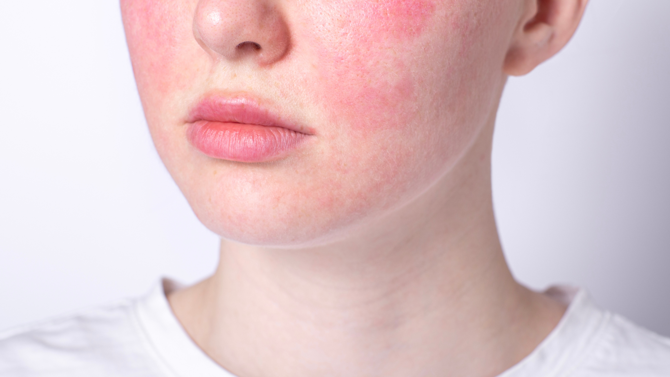 Best Moisturizer for Rosacea in 2026: ReVita-D Wins