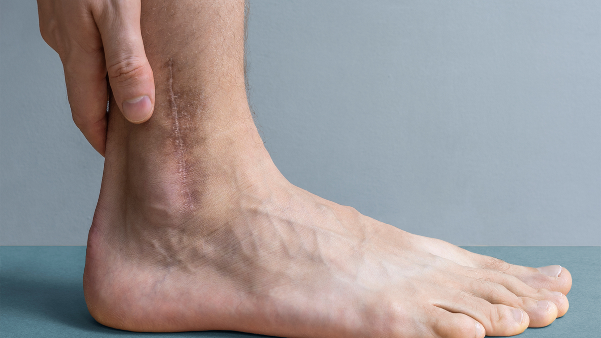 Silicone Scar Sheets for Ankle Surgery Scars (2026)