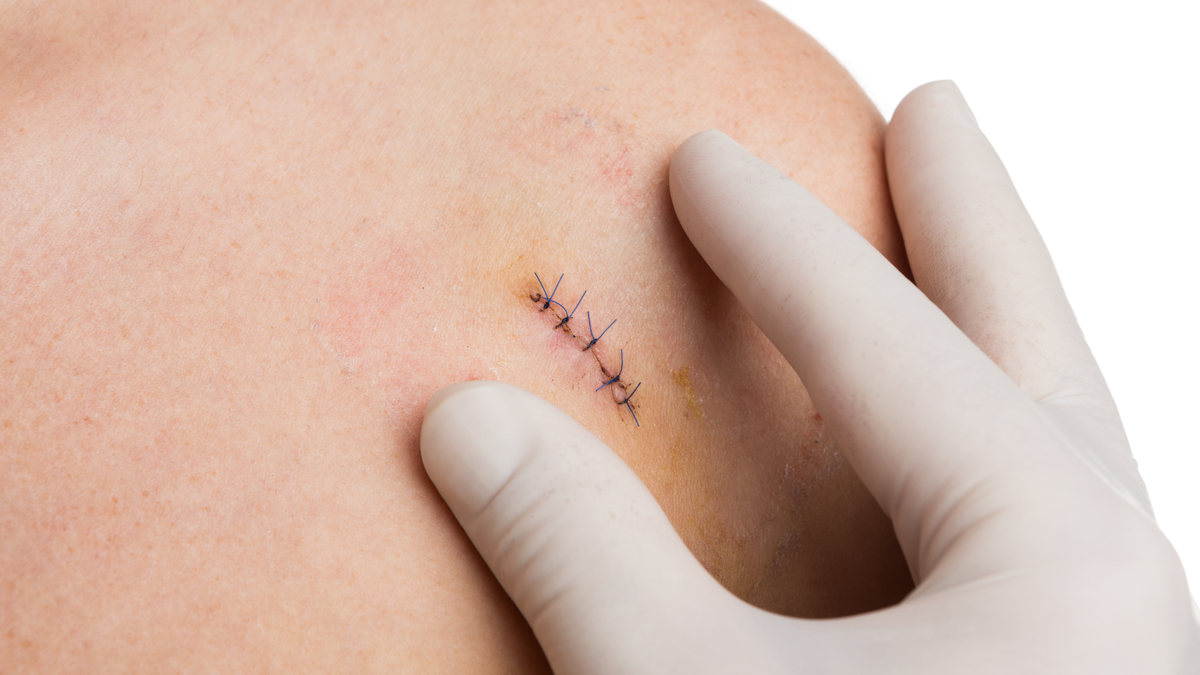 How to Prevent Scarring After Stitches: 2026 Guide