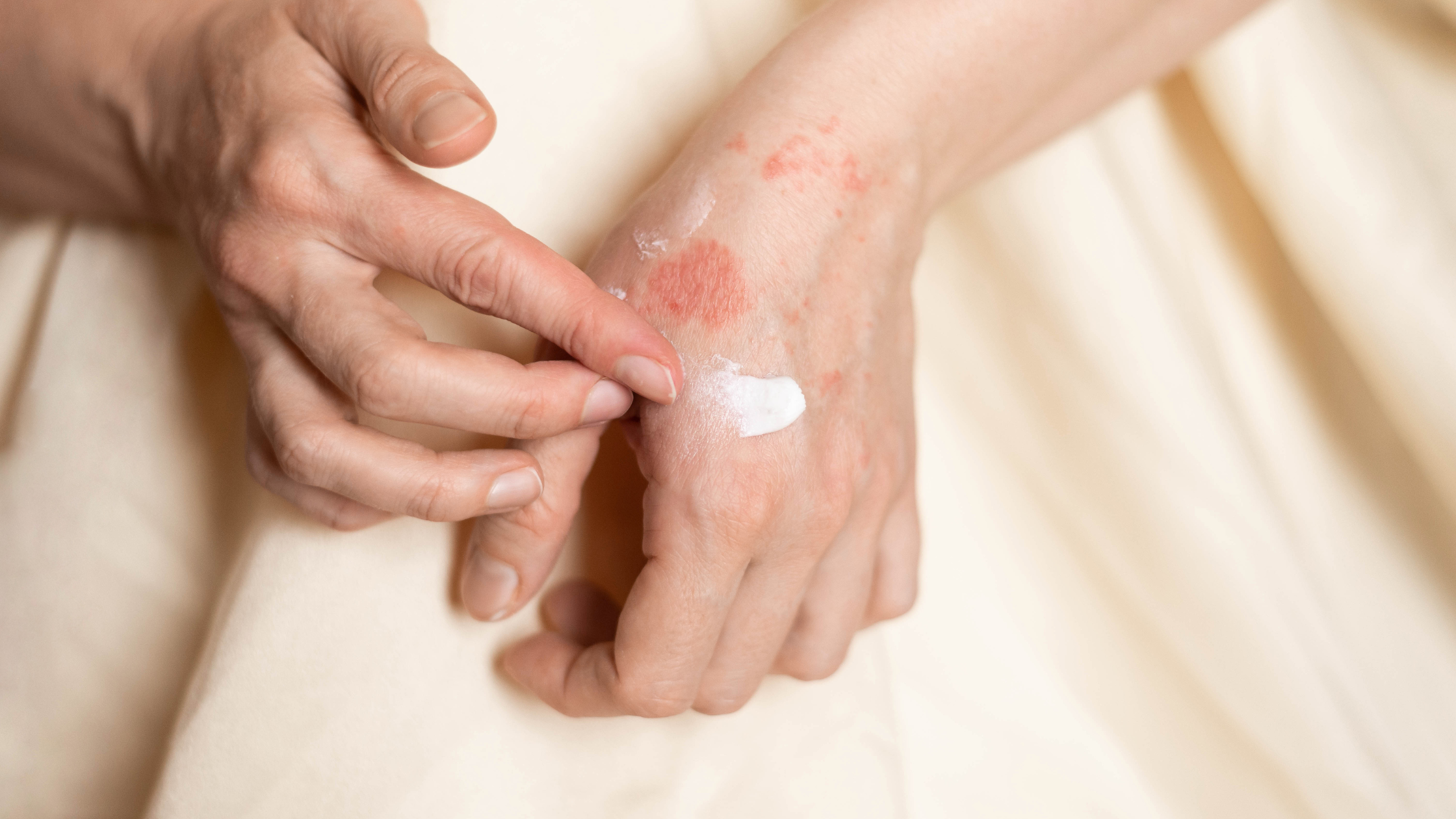 Nurture Your Skin’s Microbiome: Botanical Rescue After Eczema or Radiation