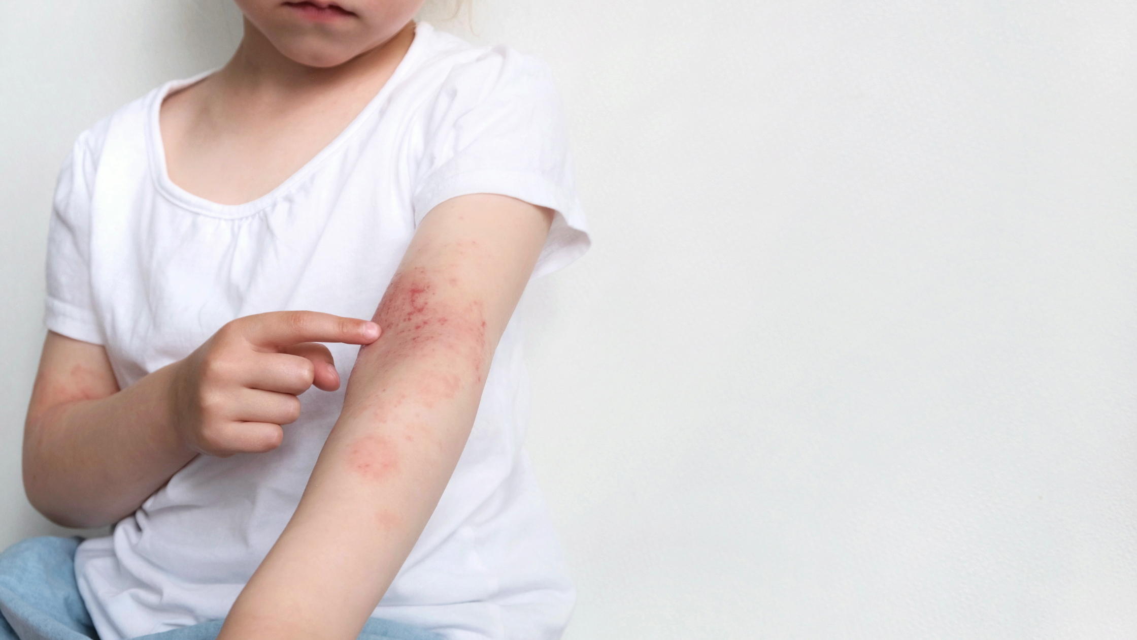 October Is Eczema Awareness Month: Soothe, Support & Strengthen Your Skin