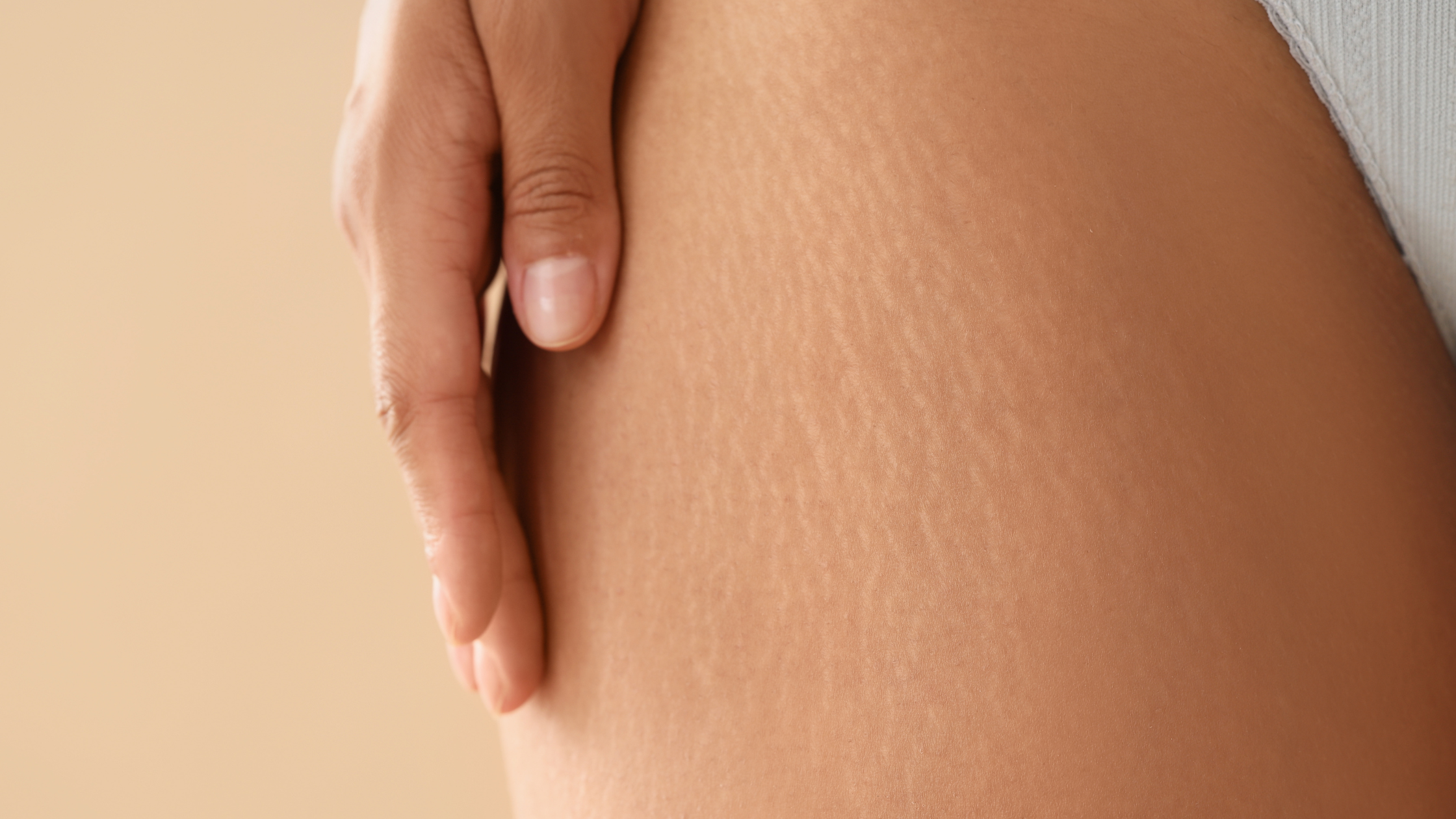 The Science Behind Effective Stretch Mark Prevention and Treatment