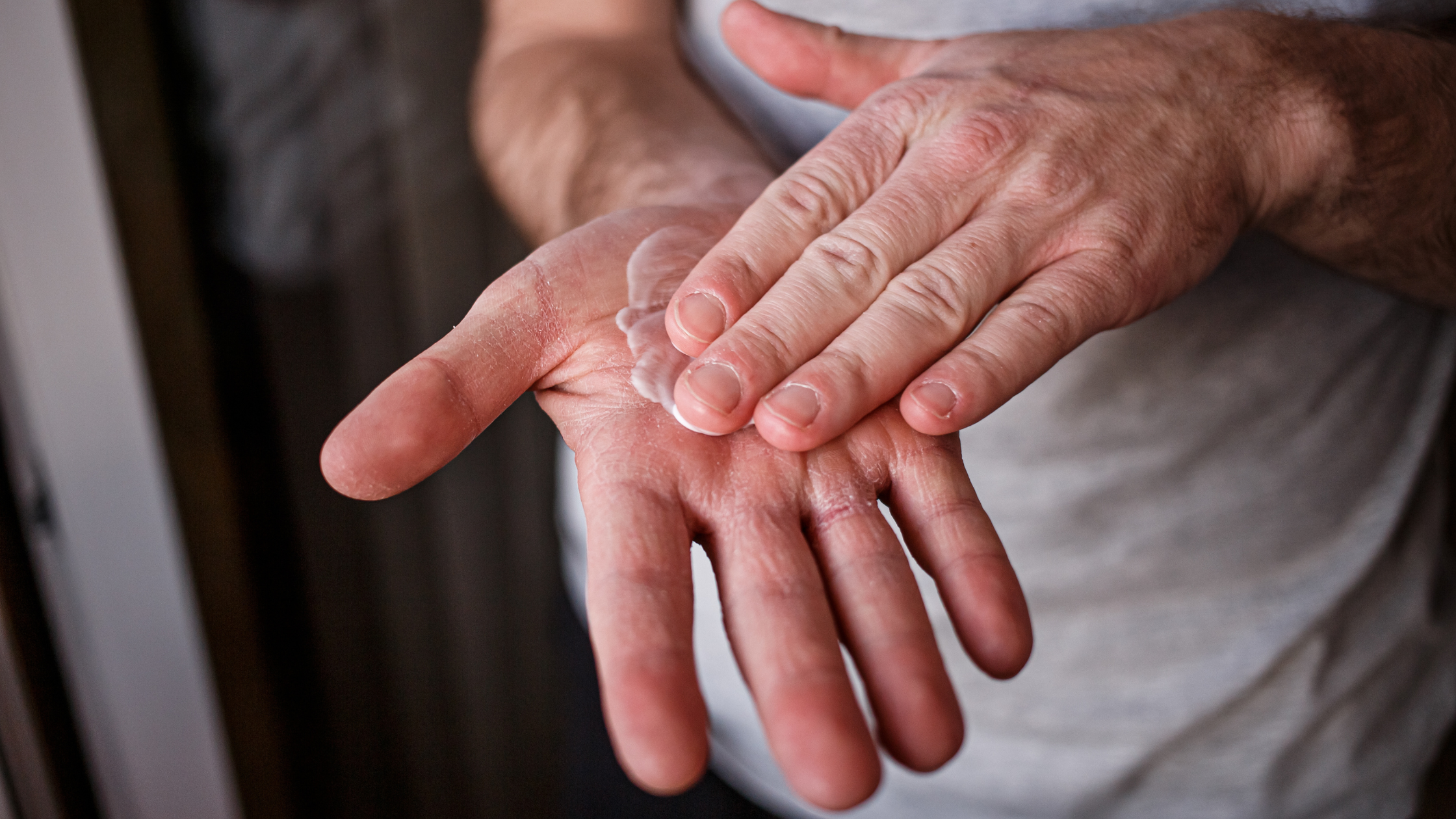 Managing Radiation Dermatitis: A Complete Guide to Soothing and Healing Skin Post-Treatment