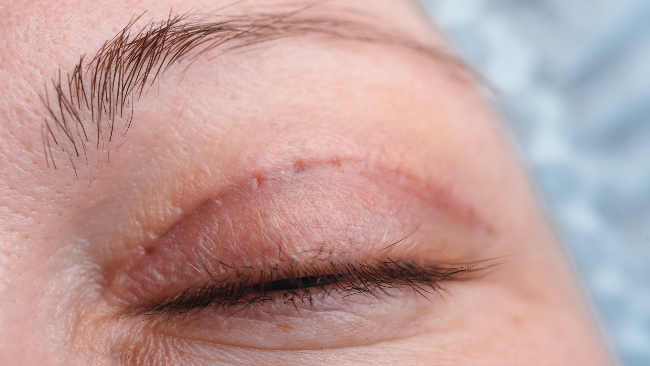 Blepharoplasty Scars: Is Silicone Scar Gel Safe Near Your Eyes?