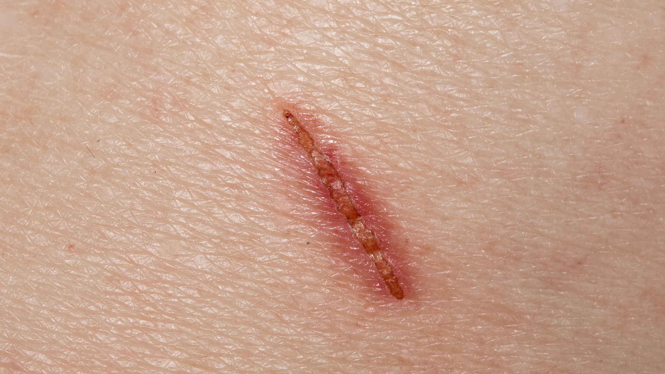 Inflammation and Scars: The Missing Link in Scar Appearance
