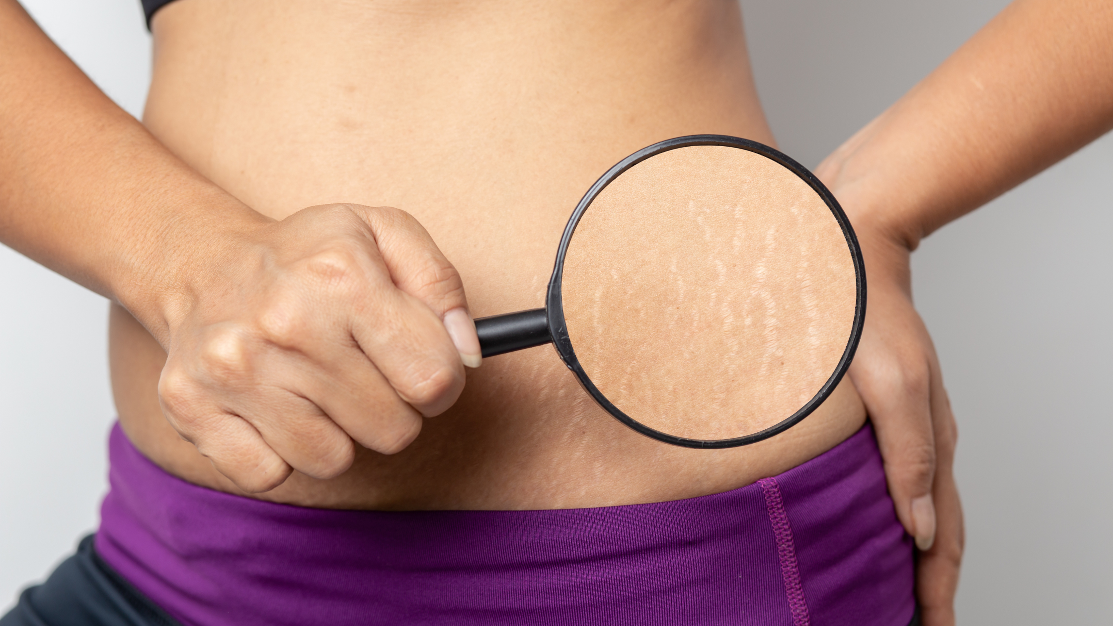 What Does the Color of Your Stretch Marks Mean? A Smart, Compassionate Guide