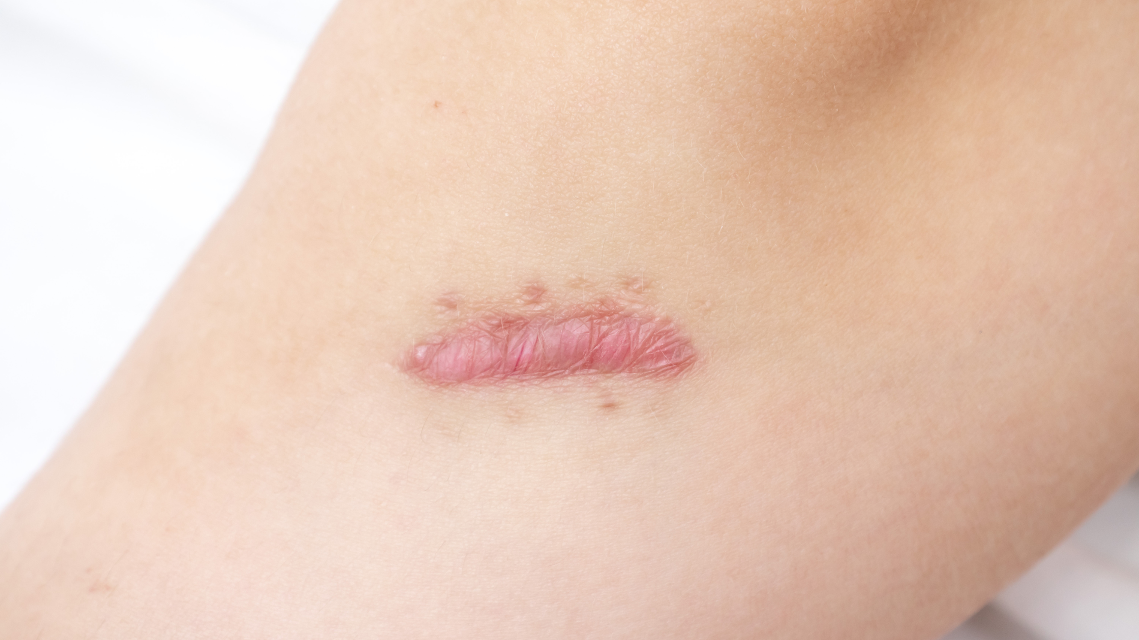 Natural and Medical Approaches to Flattening Keloid and Hypertrophic Scars