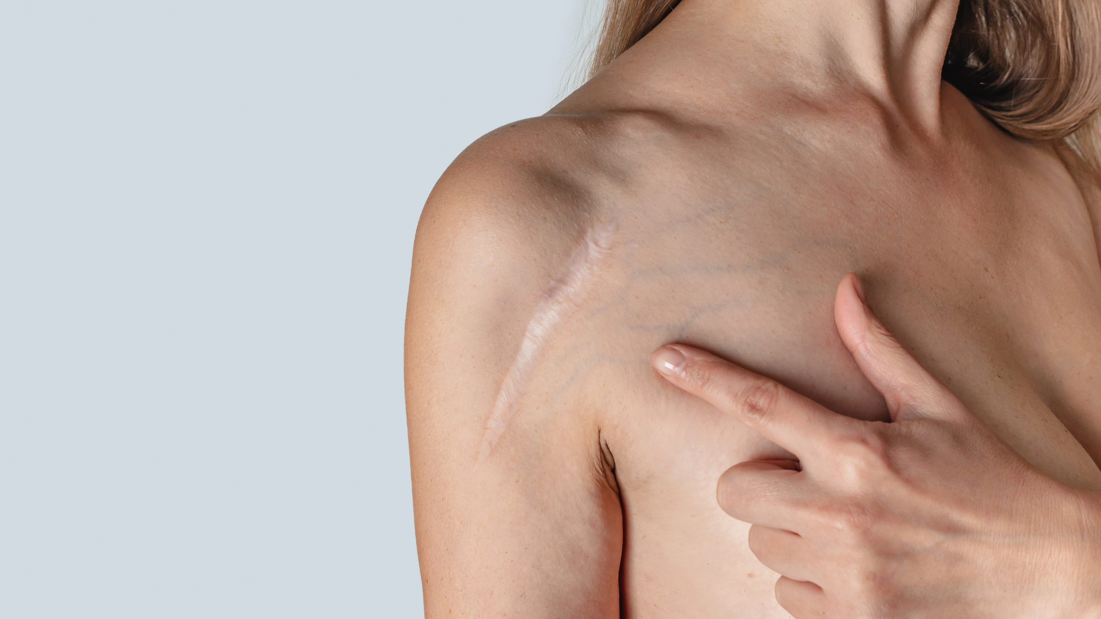 Silicone Scar Gel vs. Silicone Sheets: Which Is Right for You?