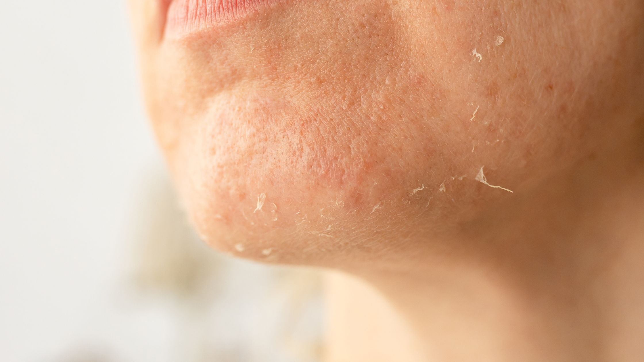 Post-Cancer Treatment Skincare: Managing Dryness, Radiation Burns & Skin Sensitivity