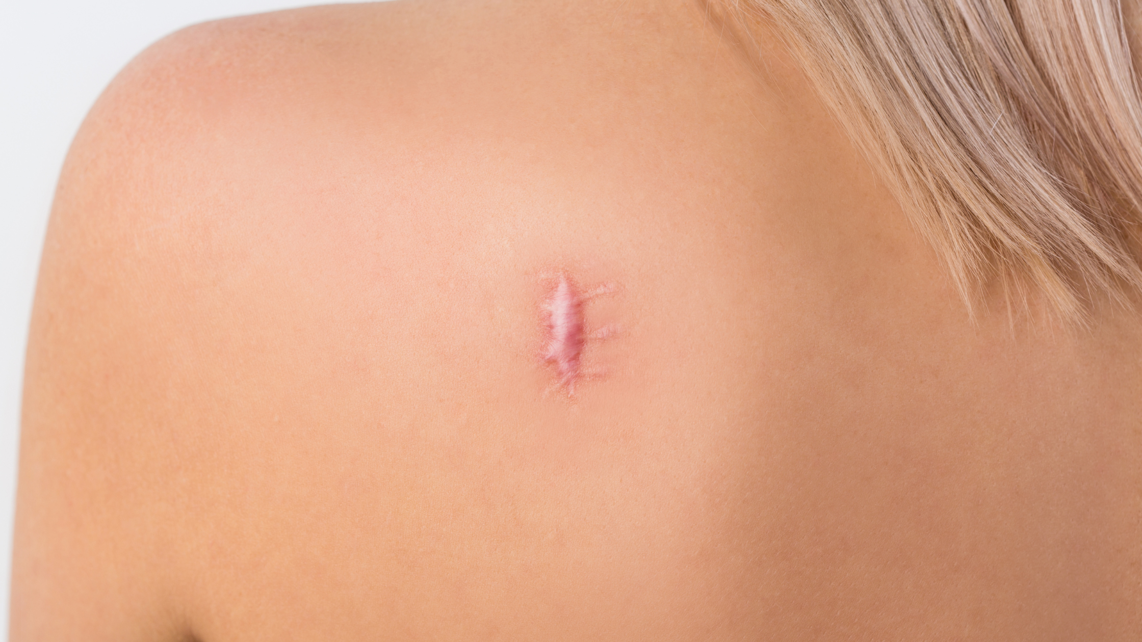 Why Surgical Scars Sometimes Feel Tight or Itchy Months Later