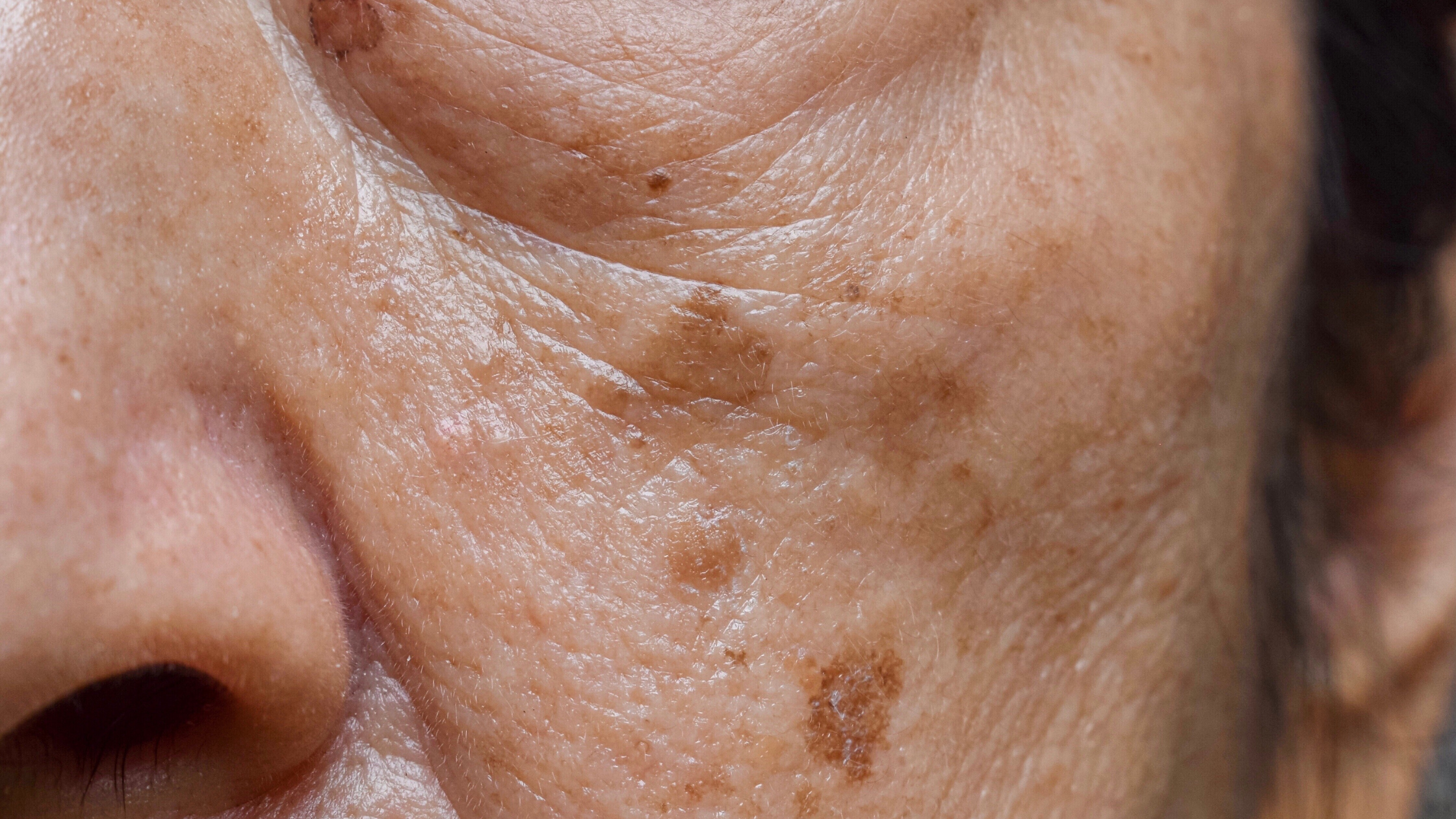 Sun Damage Reversal and Prevention: Protecting Your Skin from Aging Signs