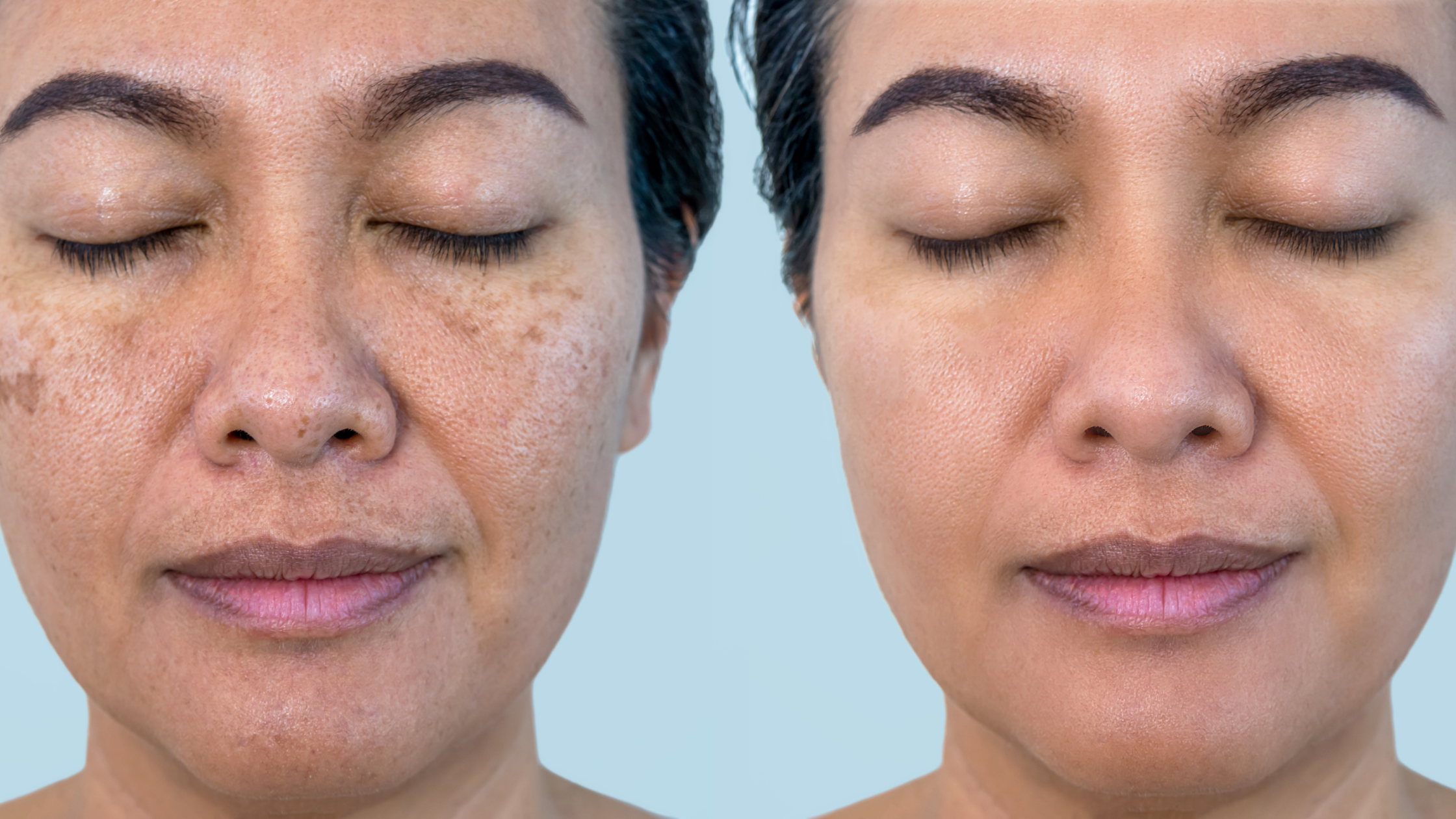 The Science and Natural Approaches to Reversing Sun Damage on the Face