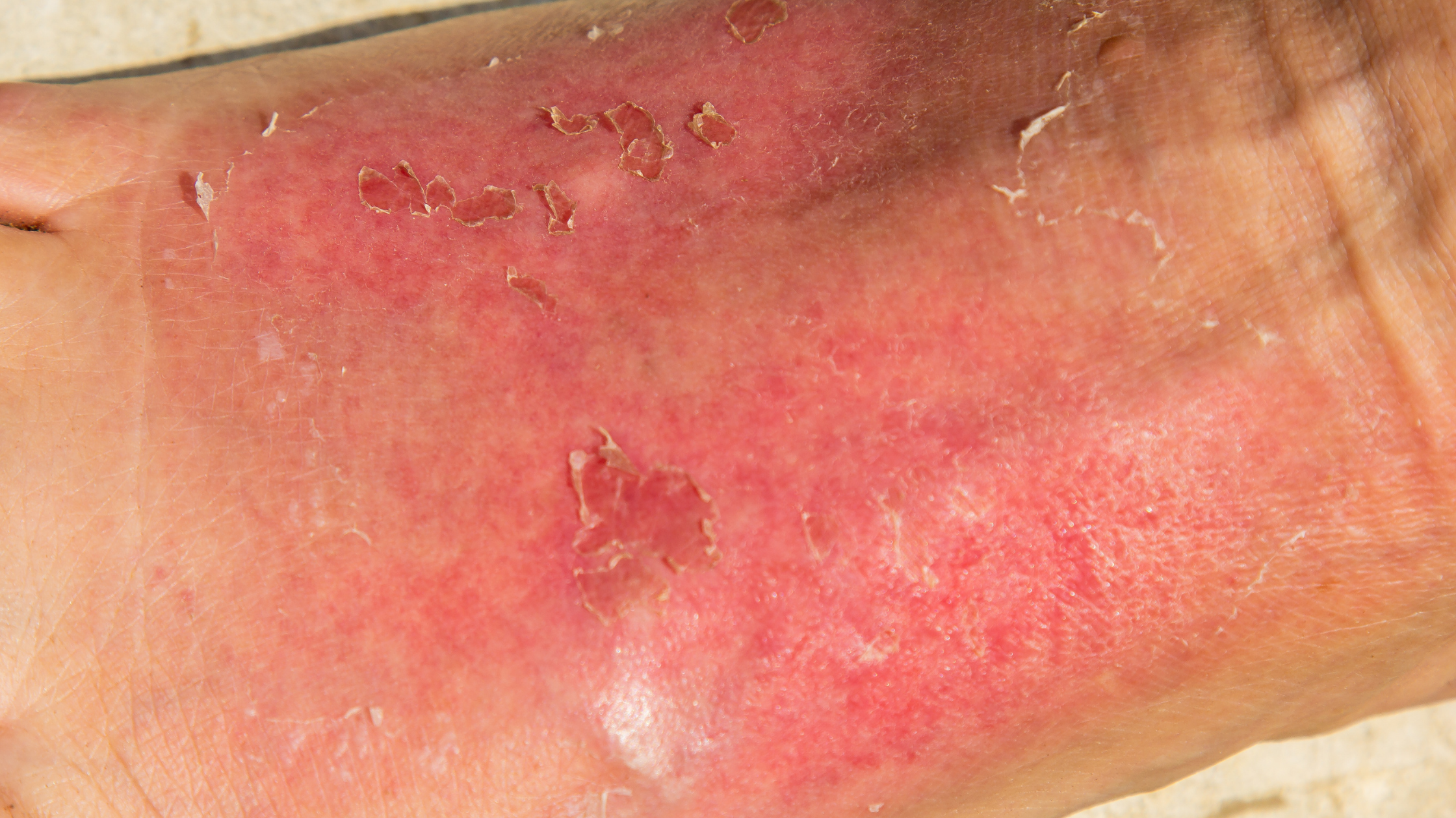 How to Manage Radiation Dermatitis