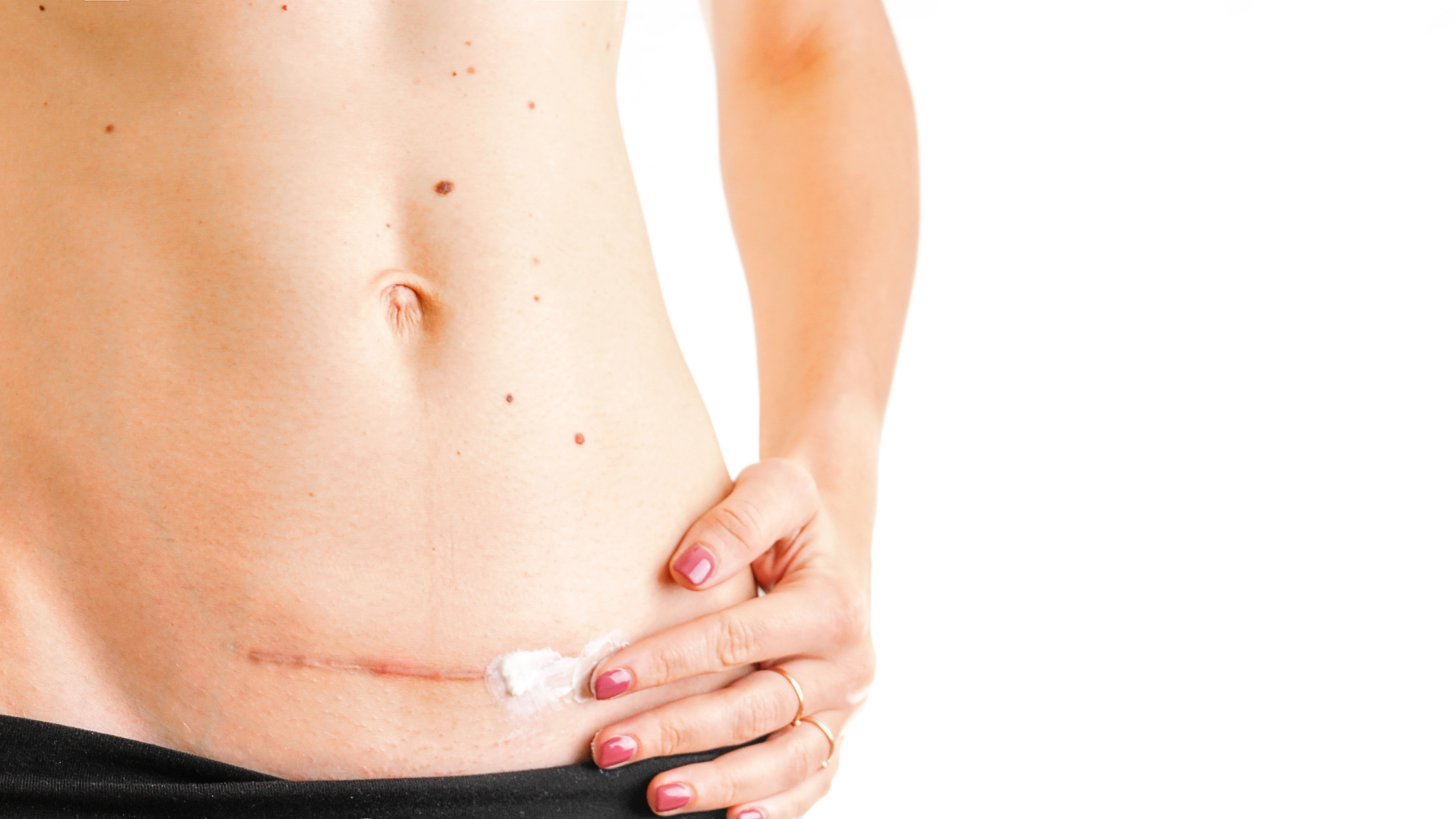 Why Is My Scar Still Red After Months—and How Can I Fade It Faster?