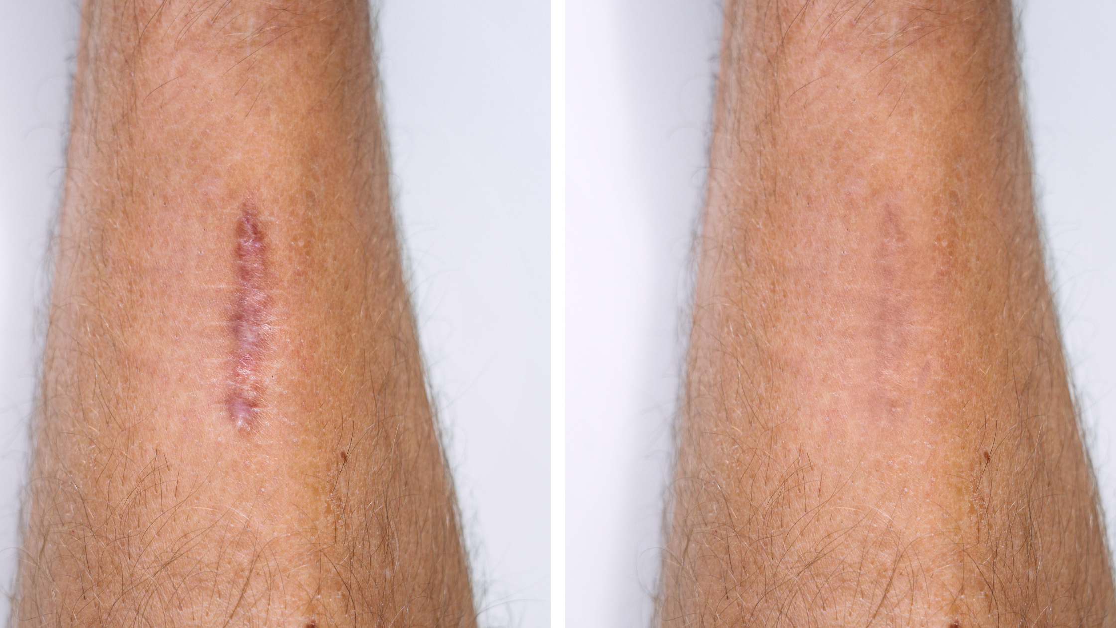 Surgical Scar Healing Stages: How to Fade Scars from Start to Finish