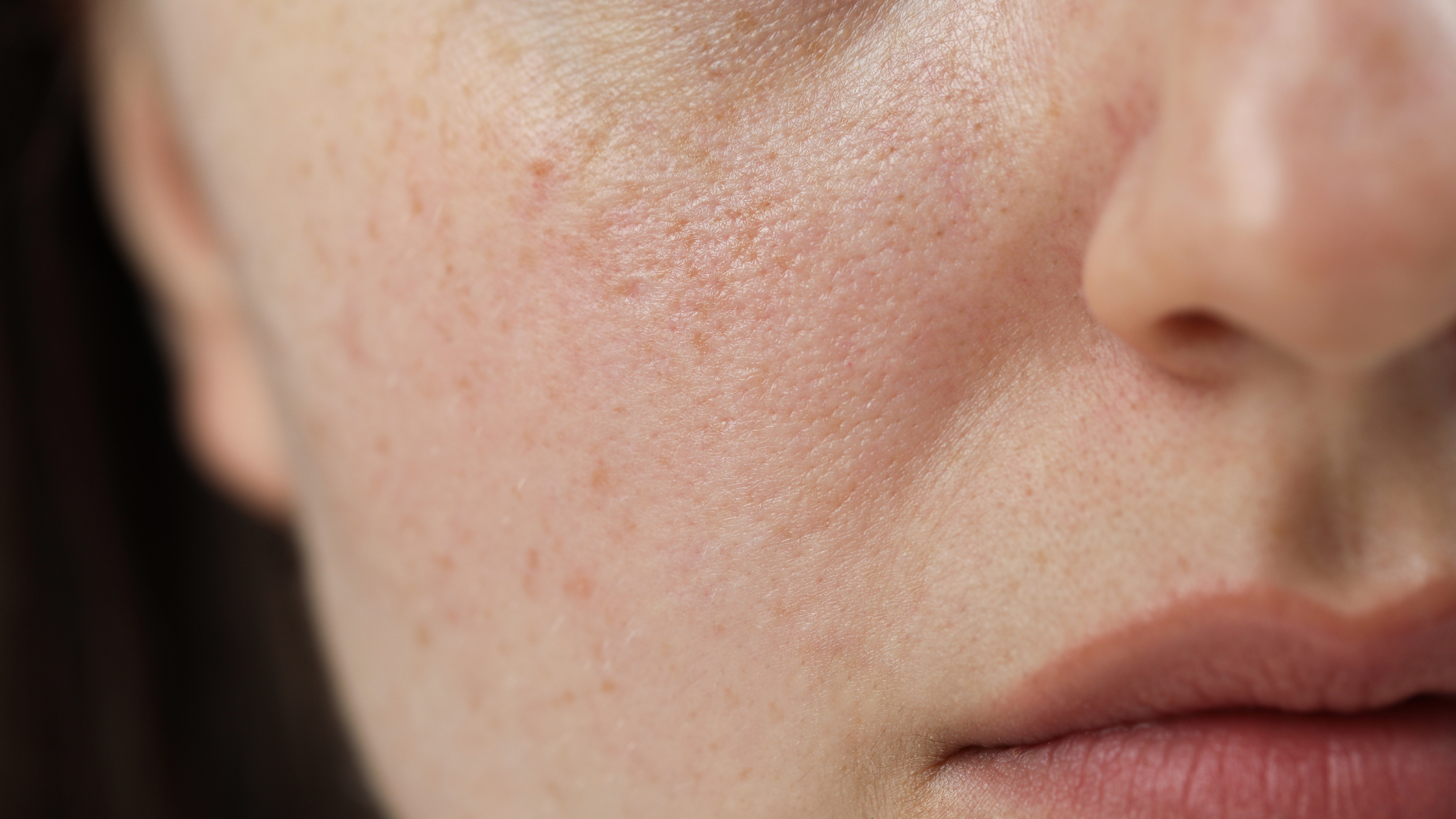 How Do You Reintroduce Active Skincare After Irritation? Tips for Supporting Your Skin Barrier