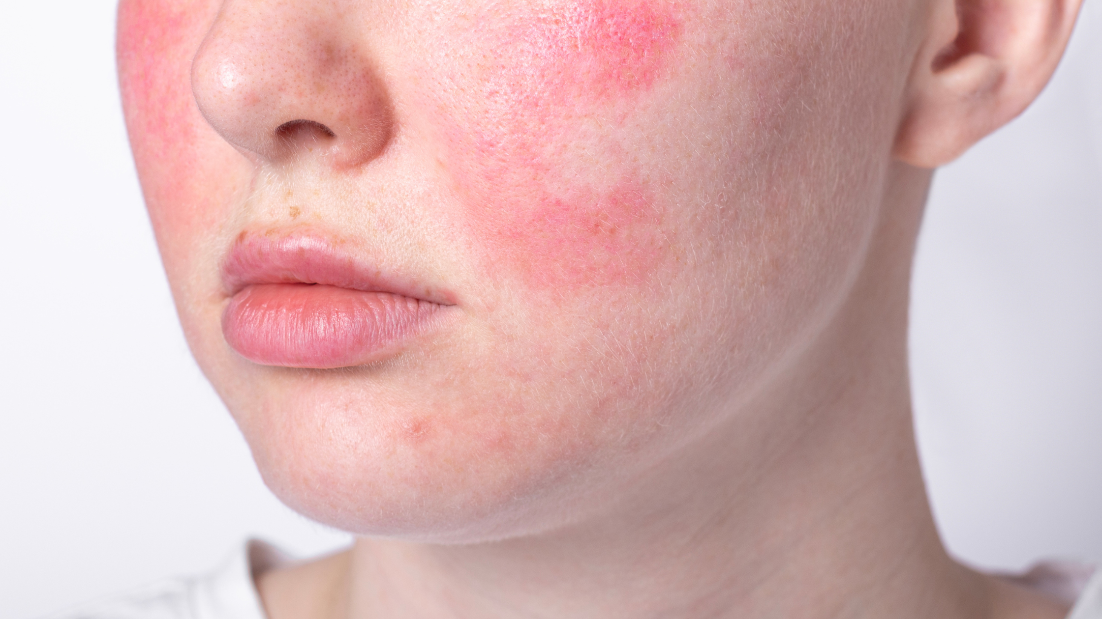 Why Skin Barrier Health Matters for Rosacea, Acne, and Sensitive Skin