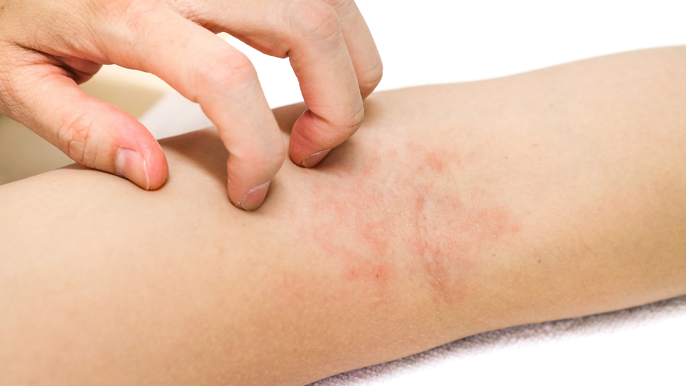 The Gut-Skin Connection: How Your Digestive Health Influences Eczema